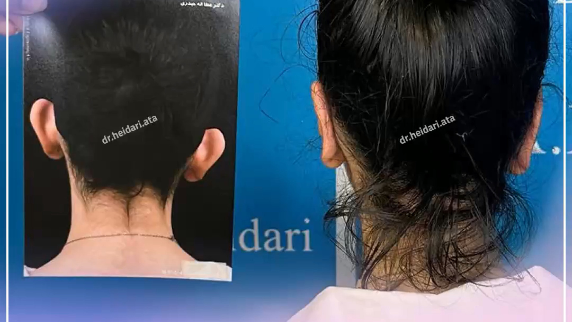 اتوپلاستی یا جراحی زیبایی گوش | دکتر عطا حیدری ایریدوتيكان