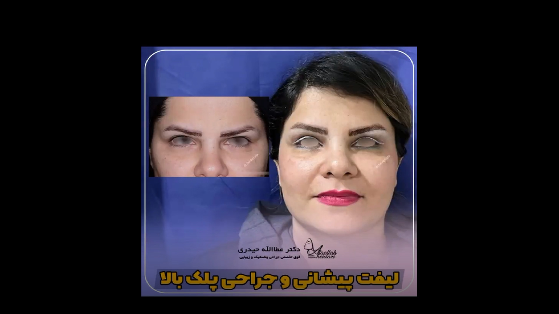 لیفت آندوسکوپی پیشانی و جراحی پلک بالا سنداکتیلی