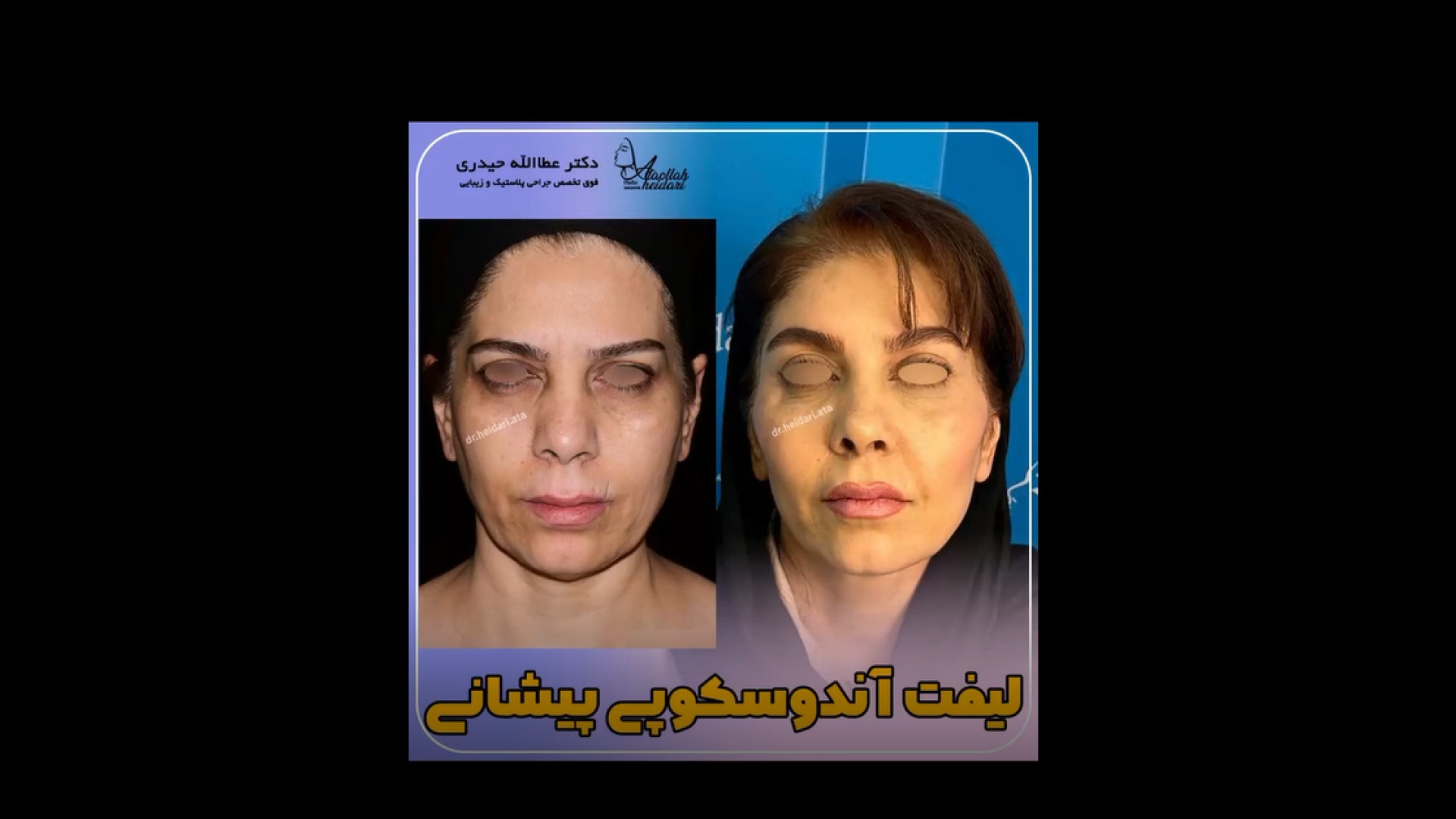نتیجه لیفت پیشانی به روش اندوسکوپی پزشکی درد مداوم