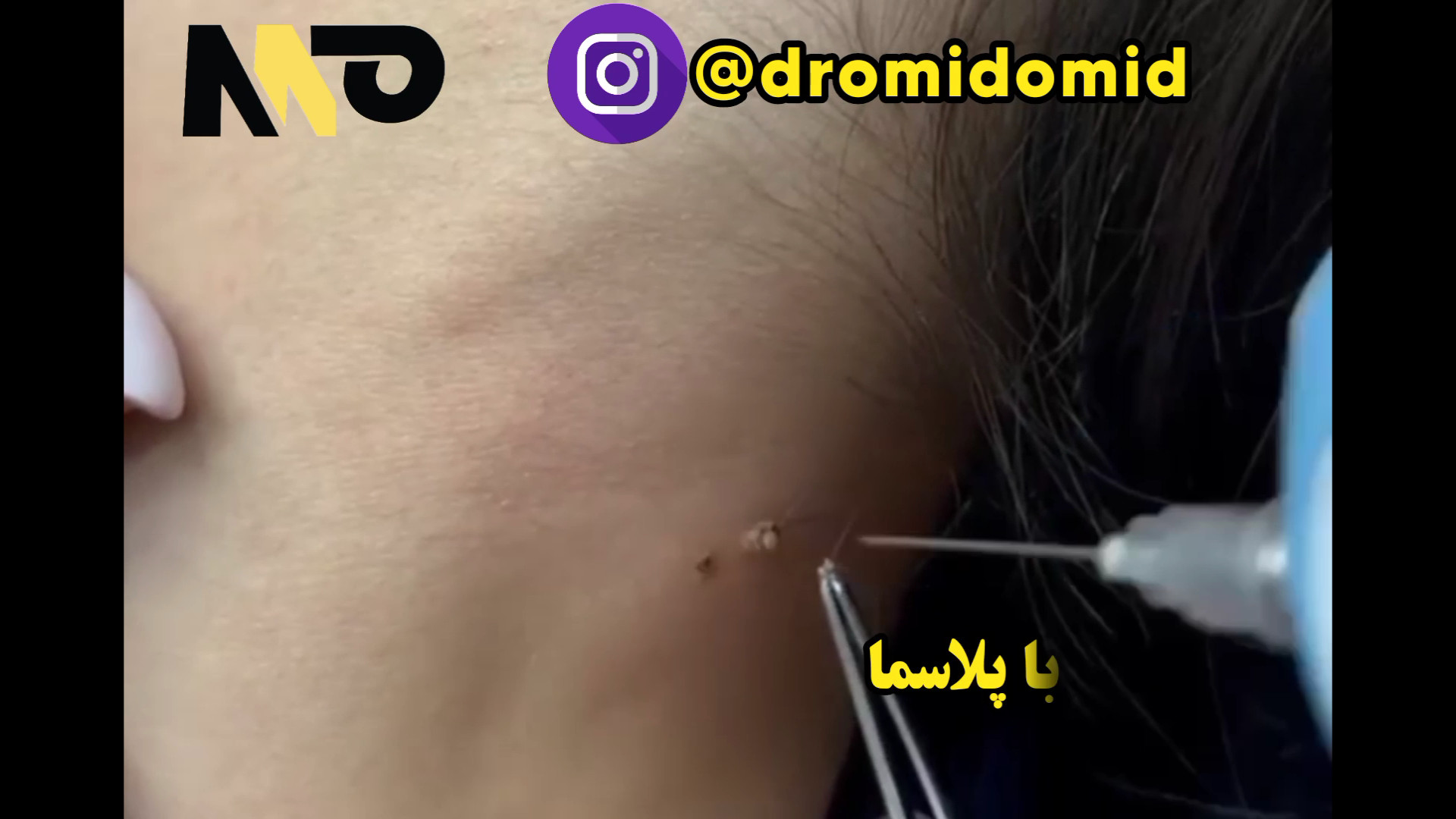 آموزش خالبرداری با پلاسما خالبرداری خالبرداری با پلاسما حذف خال جراحی پف زیر چشم