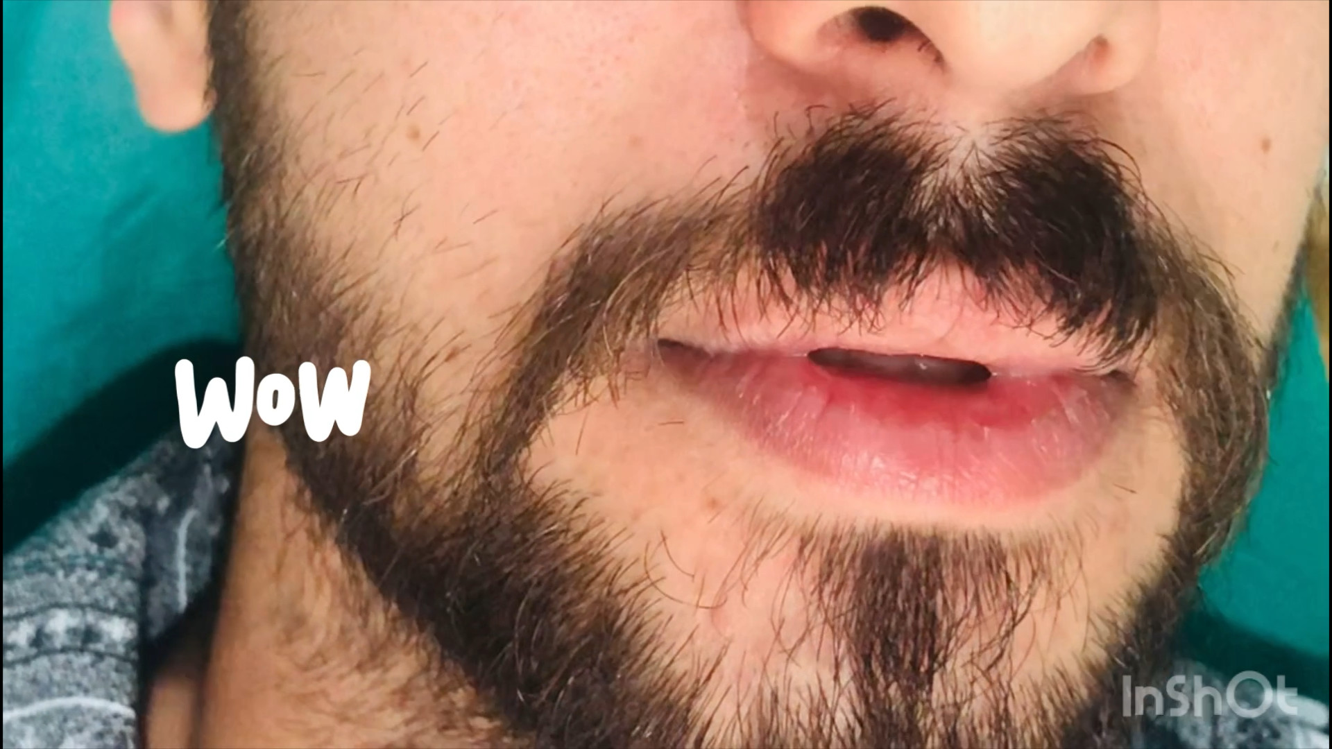 رضایت بیمار پس از دوسال از جراحی ۷واحد ایمپلنت توسط دکتر پورذکریا دکتر زکیه پورذکریا _دندانپزشک ایمپلنتولوژیست کرج