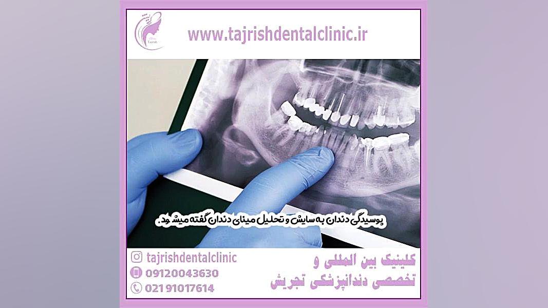 تشخیص پوسیدگی دندان از روی عکس او پی جی کامپوزیت ونیر