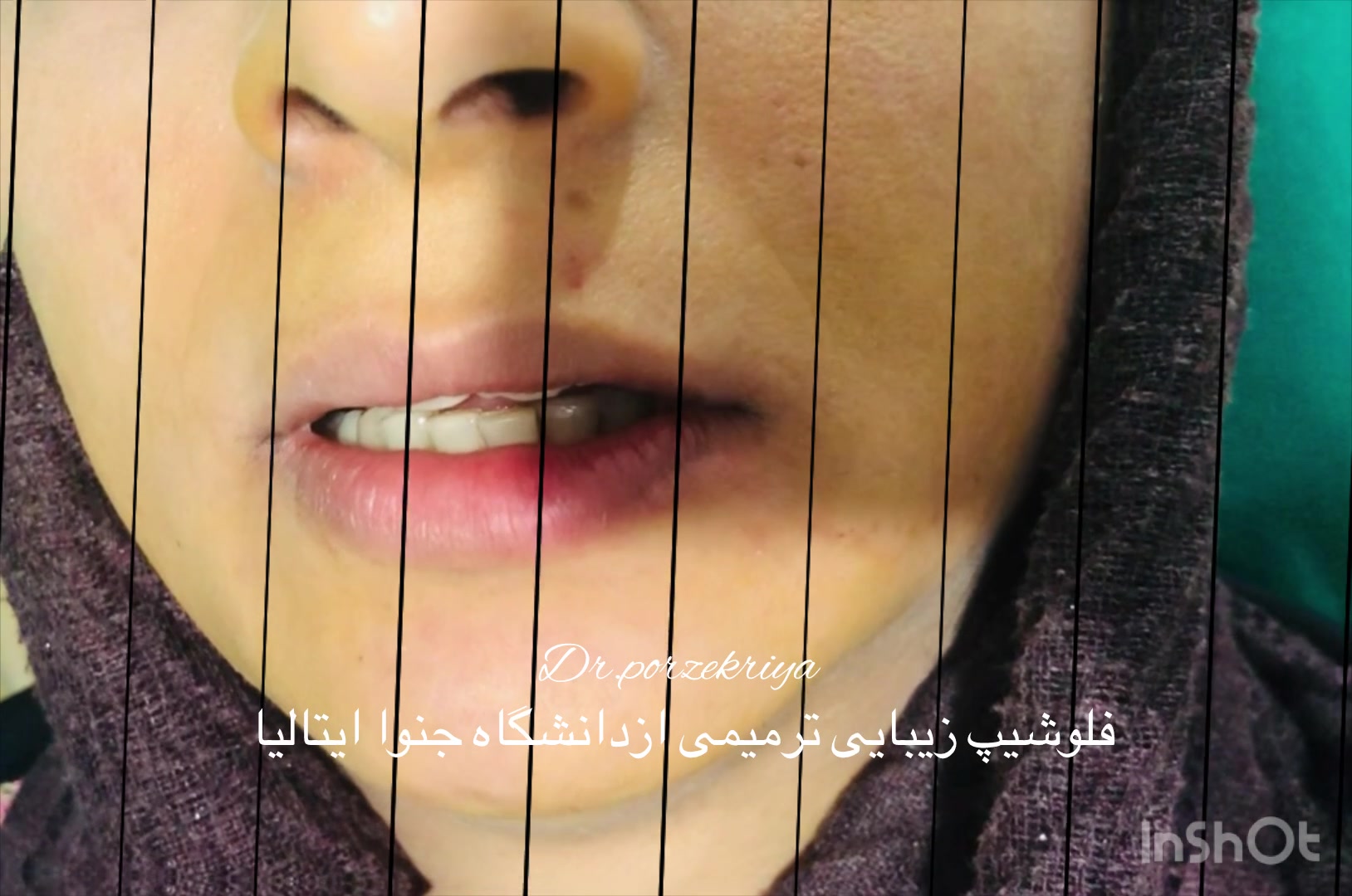 ایا کاشت دندان implant درد دارد؟ بیمار دکتر پورذکریا به این سوال پاسخ می دهد دکتر زکیه پورذکریا _دندانپزشک ایمپلنتولوژیست کرج