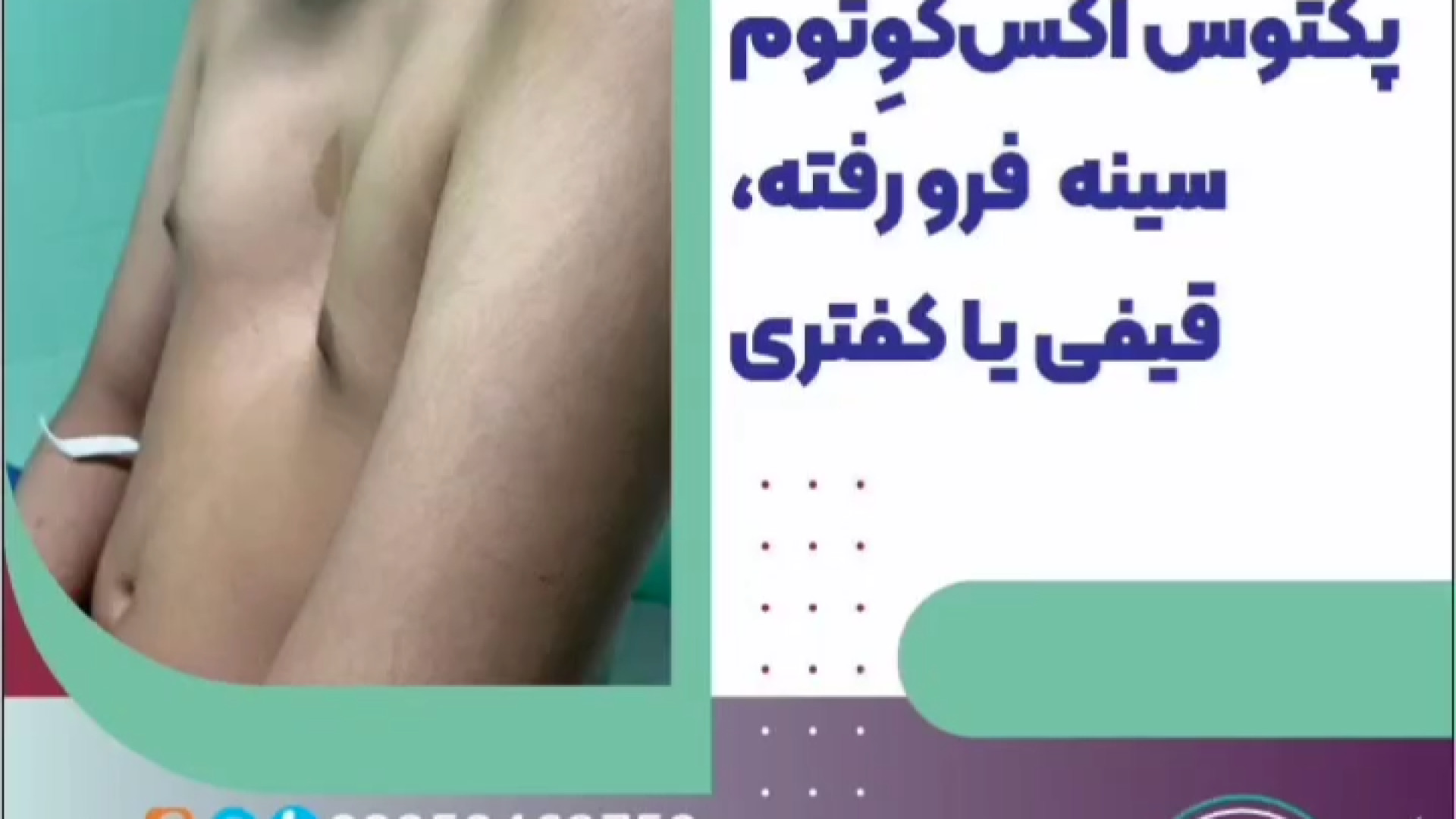 پکتوس اکس کَوِتوم ، سینه فرورفته ، قیفی یا کفتری دکتر رضا باقری جراح سینه در مشهد