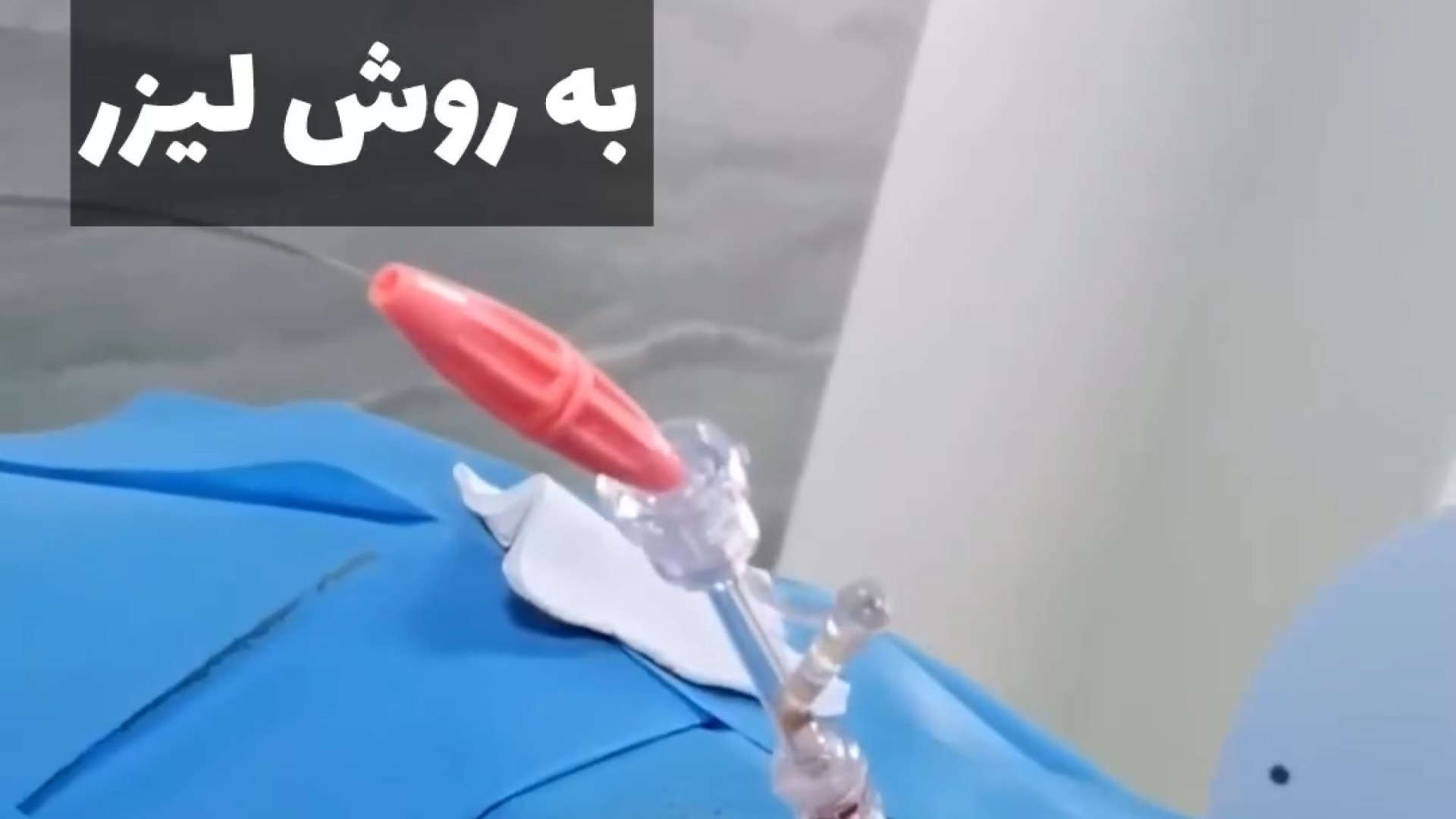 درمان دیسک کمر سرپایی به روش لیزر کاشت ابرو