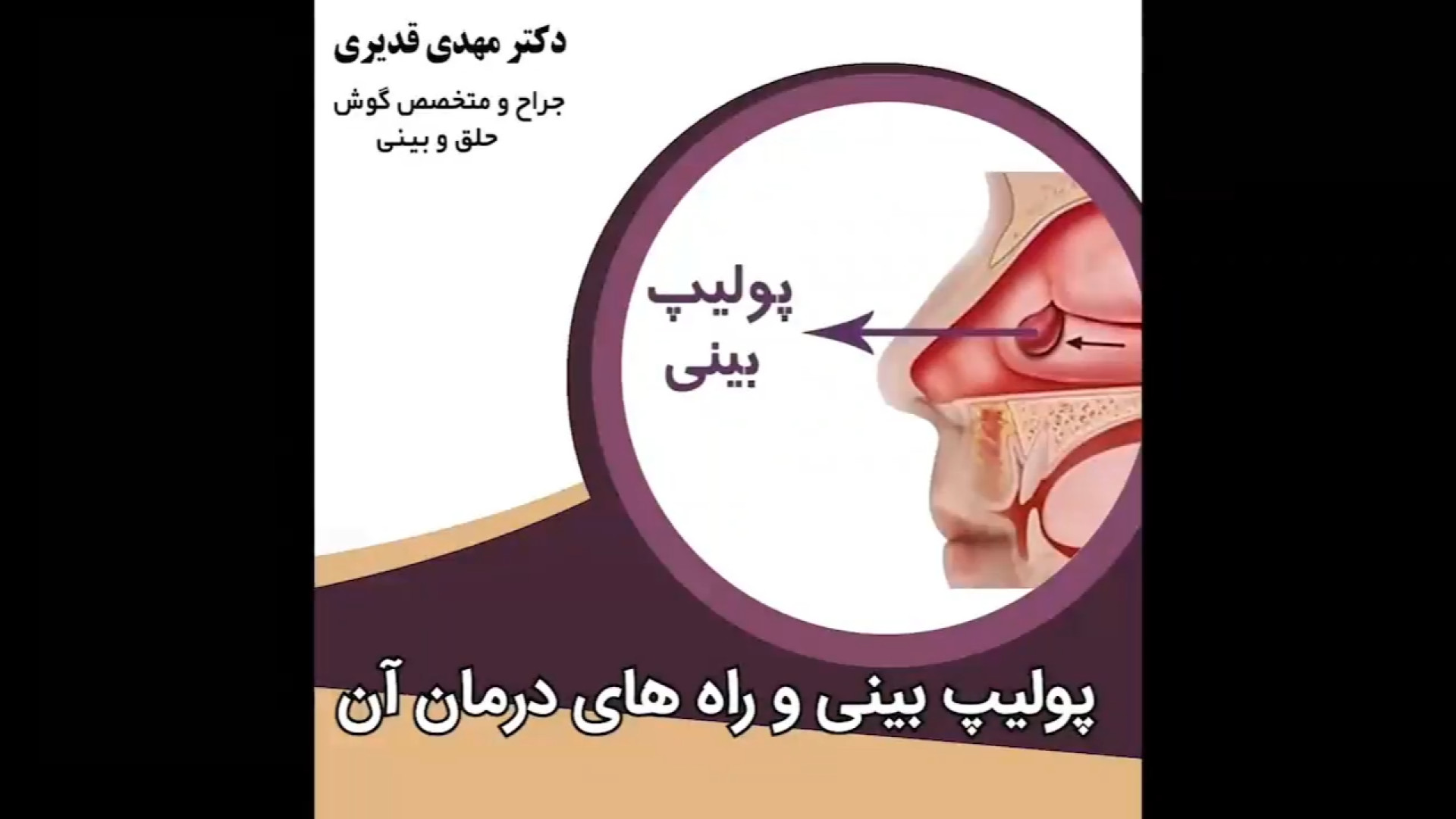 جراحی پولیپ بینی دکتر مهدی قدیری