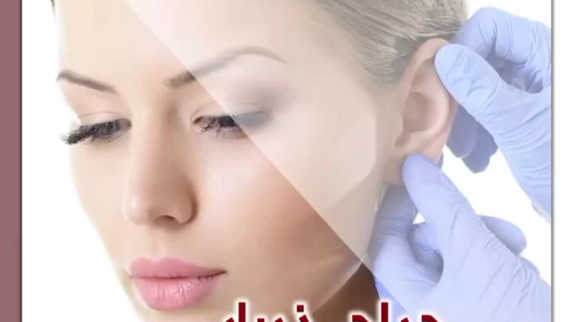 جراحی زیبایی گوش بیماری سندروم آلاژیل
