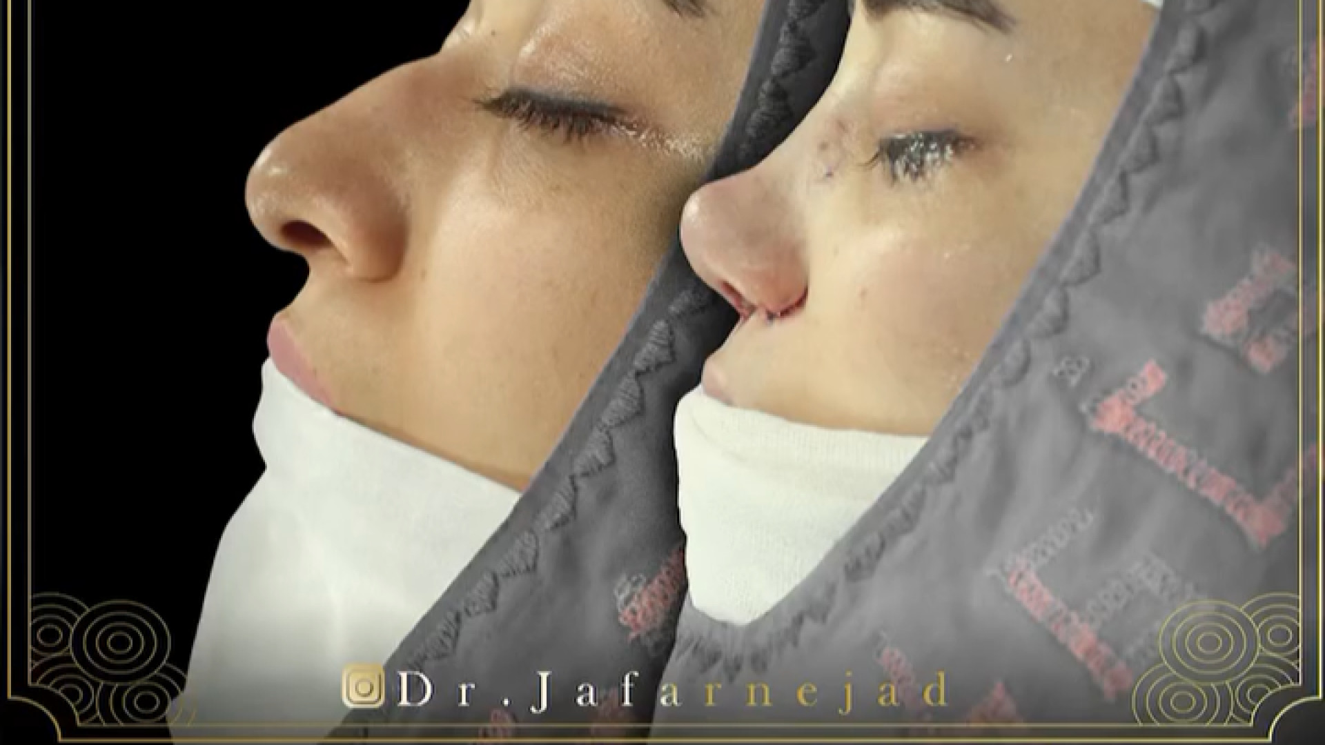 عمل بینی زنانه دکتر بابک جعفرنژاد