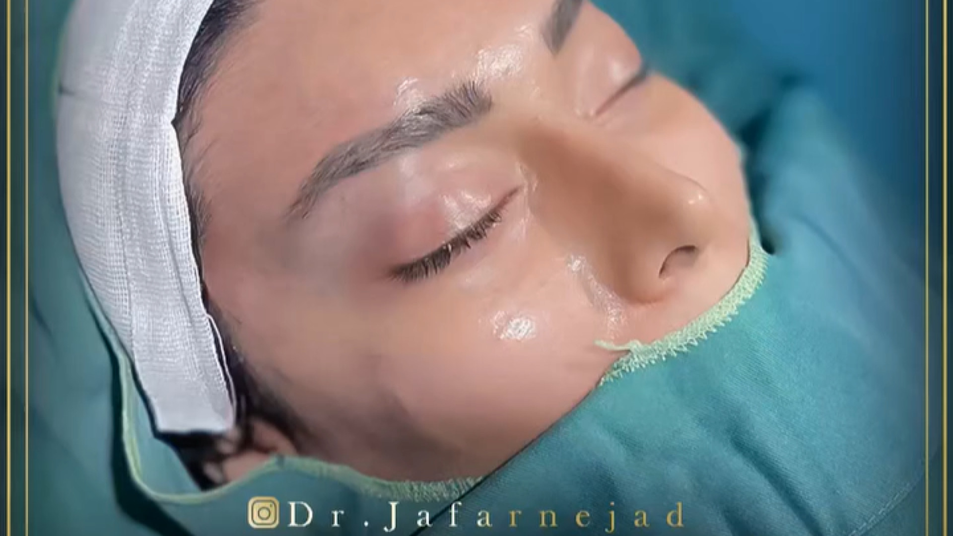 لیفت گونه و ابرو دکتر بابک جعفرنژاد