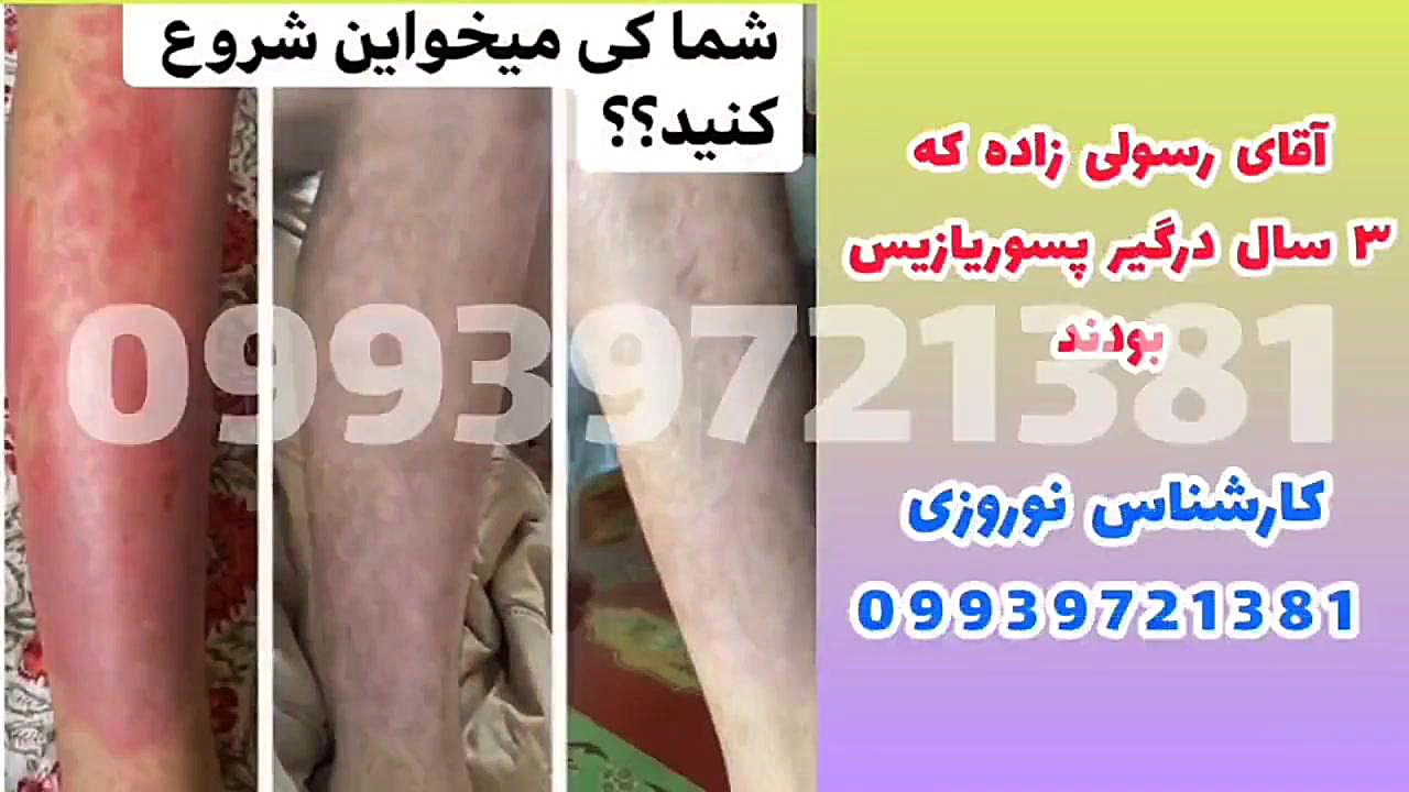 پسوریازیس در مردان دست و پا چلفتی