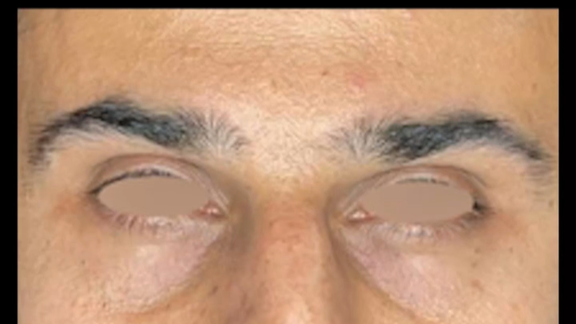 تزریق فیلر زیر چشم دکتر صدیقه نائیجی | متخصص پوست و مو در قم