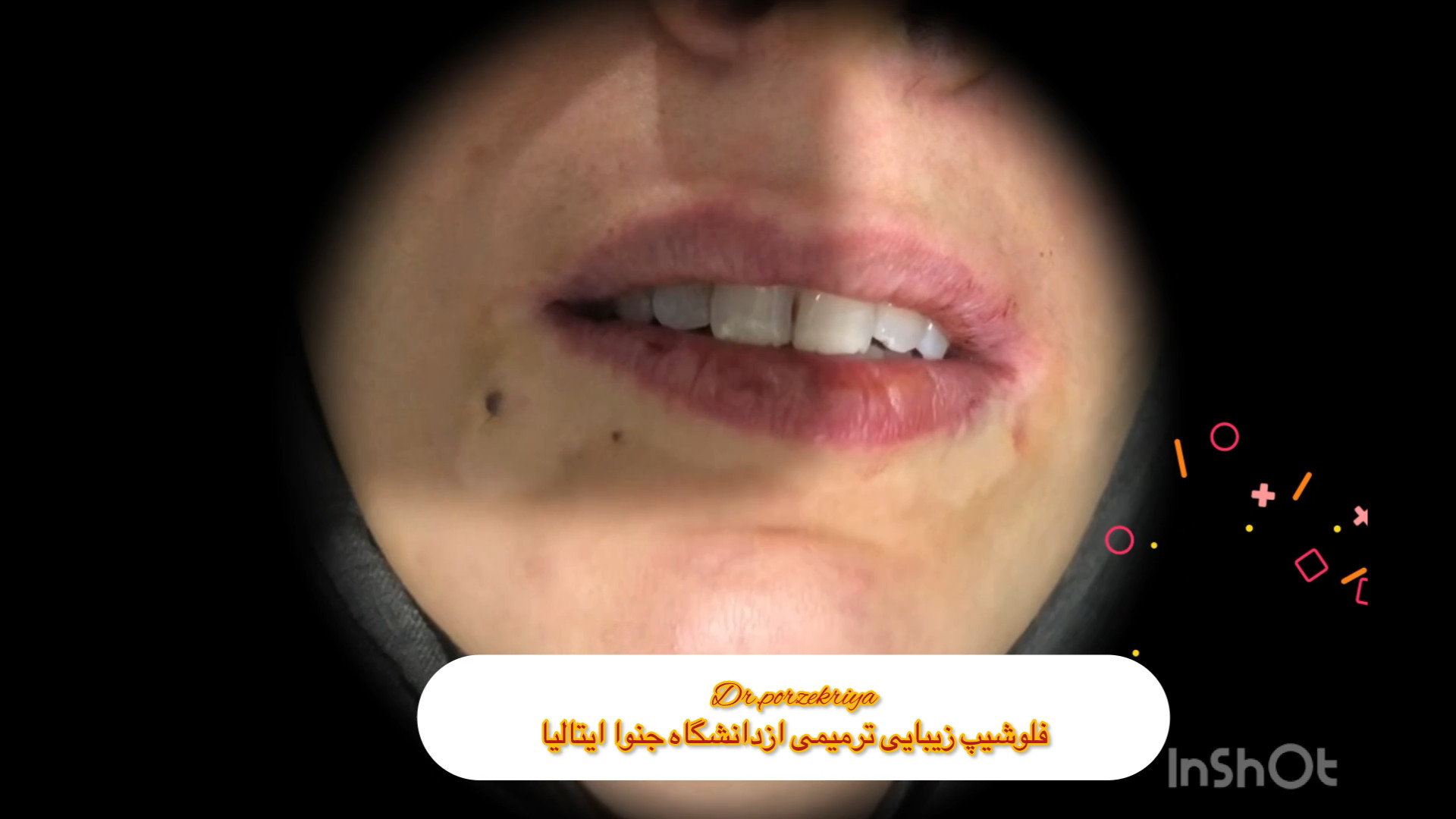 رضایت مراجعه کننده ، از جراحی ایمپلنت در دندانپزشکی تخصصی دکتر پورذکریا دکتر زکیه پورذکریا _دندانپزشک ایمپلنتولوژیست کرج