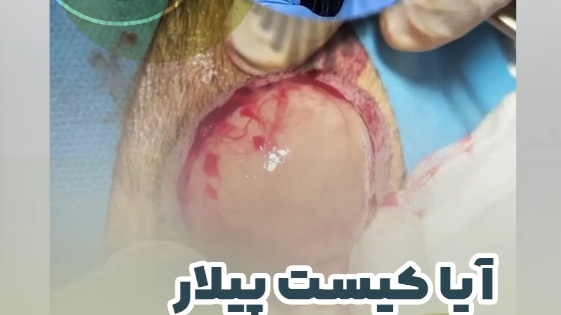 ریزش مو در اثر کیست پیلار دکتر ایمان روغنی جراح و متخصص پوست و مو