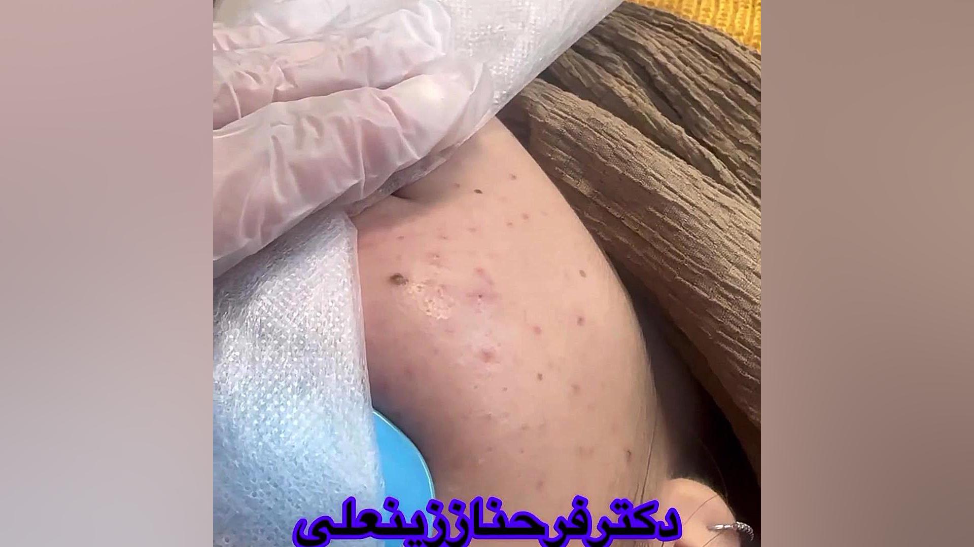 رفع خال های صورتتان با استفاده از لیزر بدون اینکه اسکار بجا بماند دکتر فرحناز زینعلی - متخصص پوست، مو، زیبایی زنجان