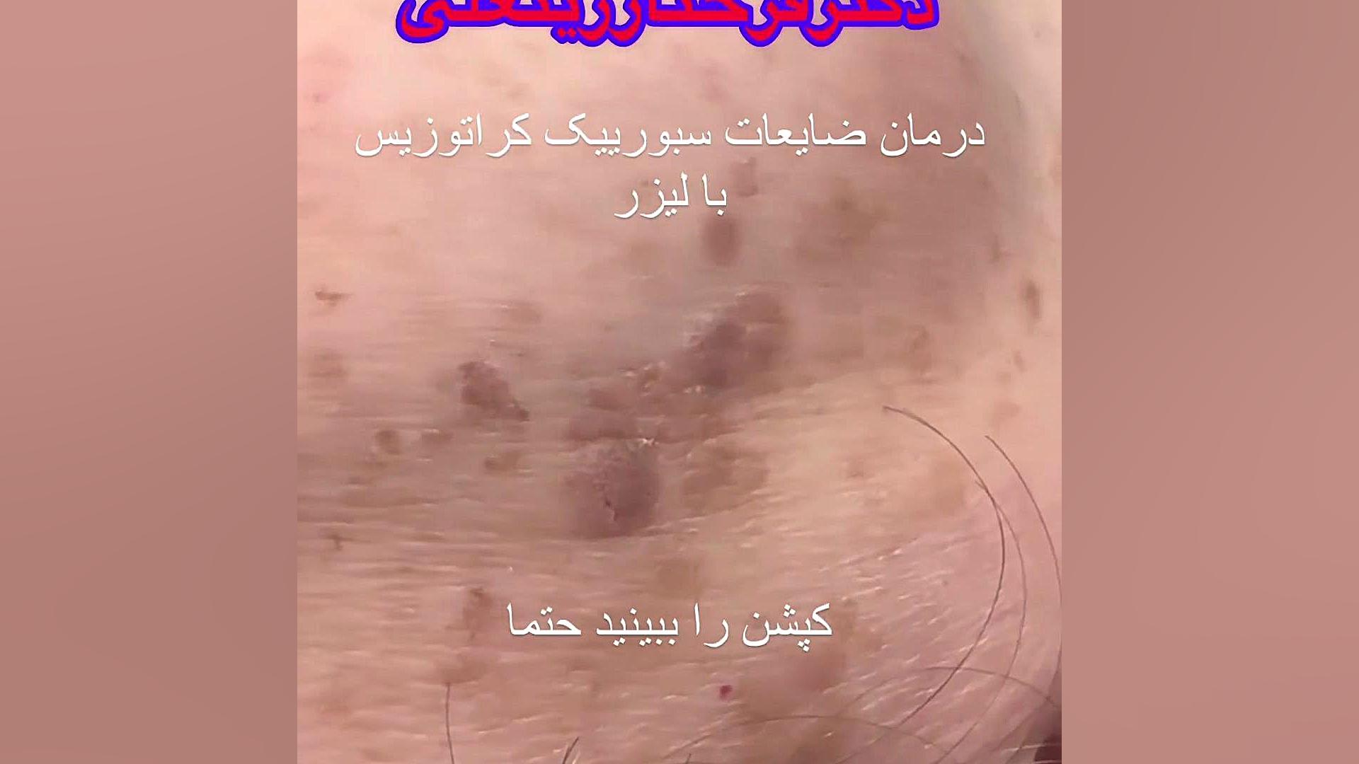 رفع دائمی ضایعات پوستی دکتر فرحناز زینعلی - متخصص پوست، مو، زیبایی زنجان