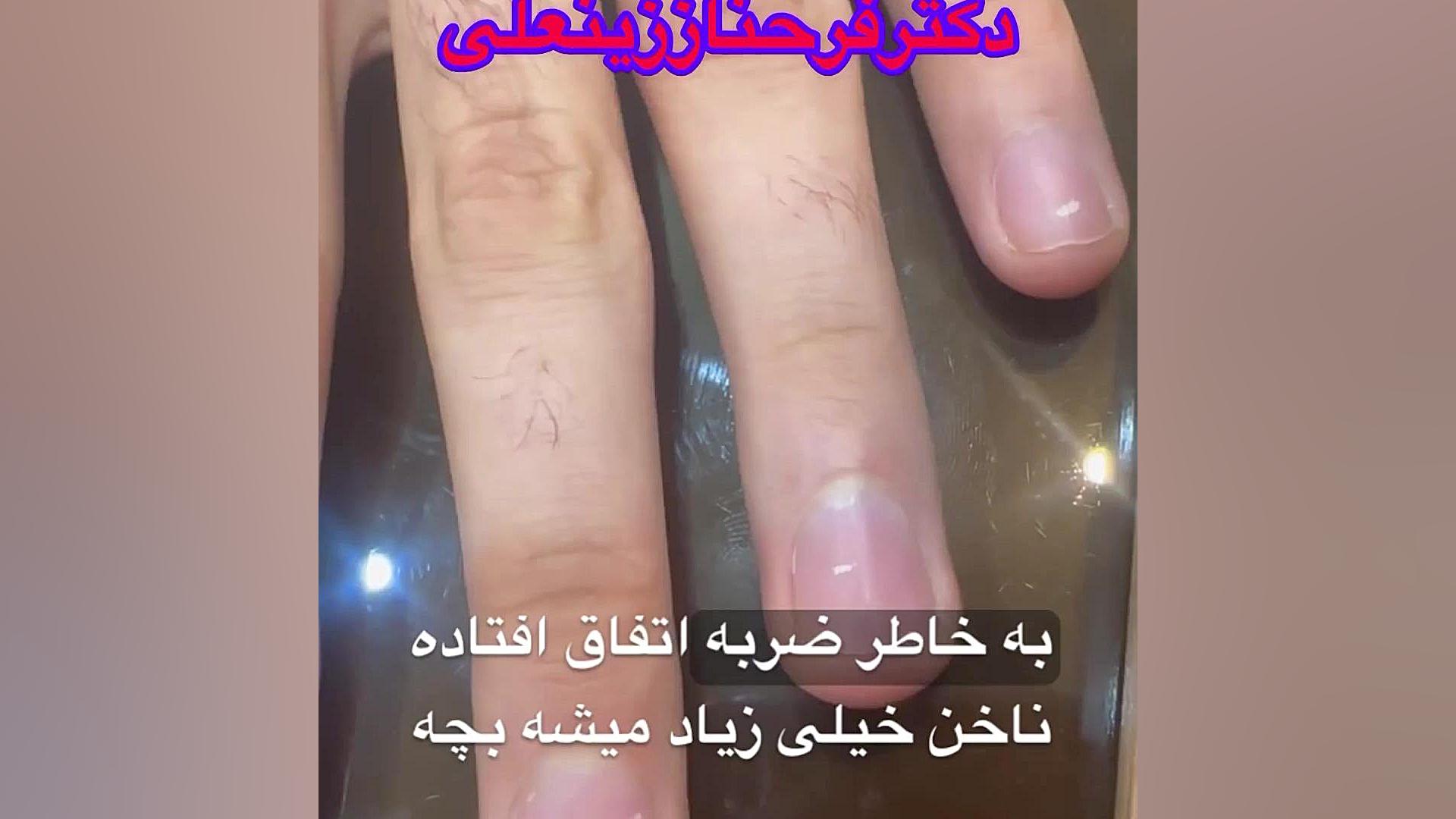 لکونشیای نقطه ای اکثرا بعلت تروما و ضربه ایجاد میشود بلیچینگ دندان
