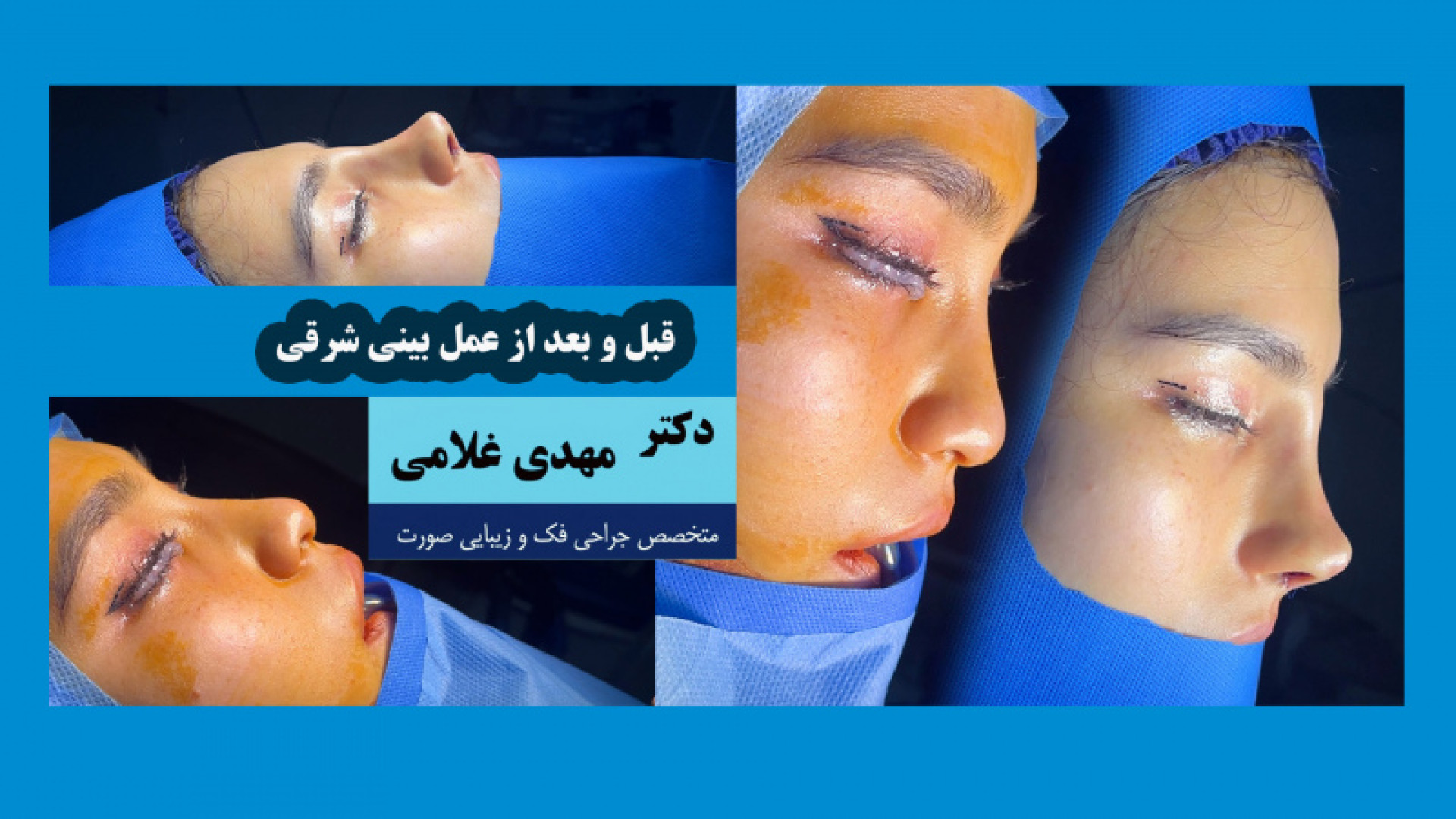 قبل و بعد از جراحی بینی شرقی با دکتر مهدی غلامی در مشهد دکتر مهدی غلامی