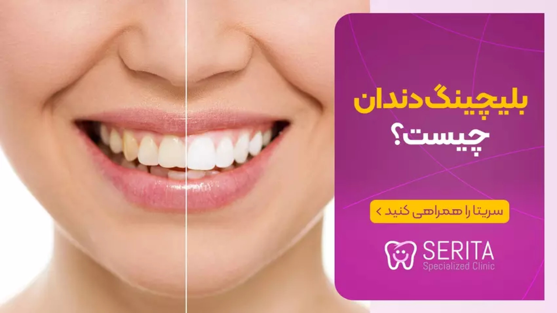 همه چیز در مورد بلیچینگ دندان سیستم نانواینژکتور