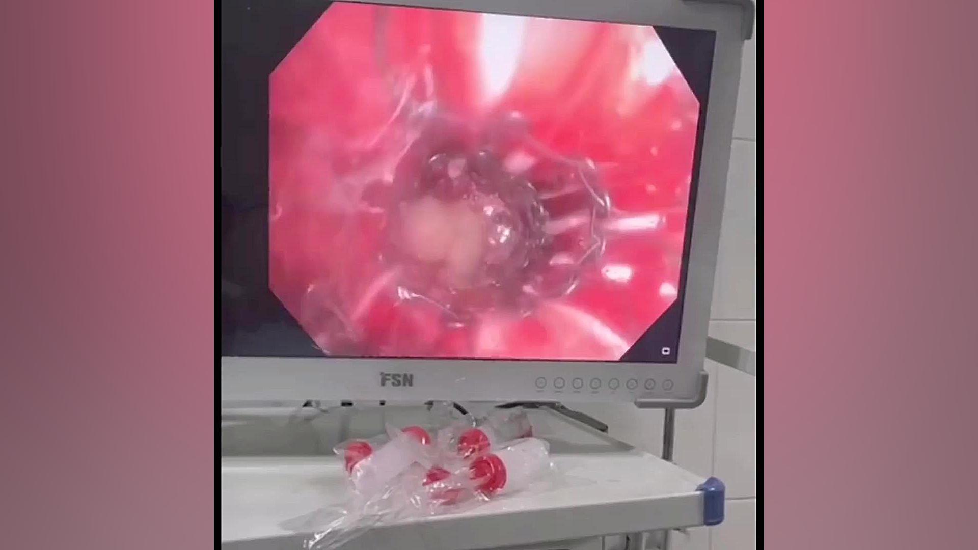 تخریب توموری که ریه راست را کاملا مسدود کرده بود هپروتی