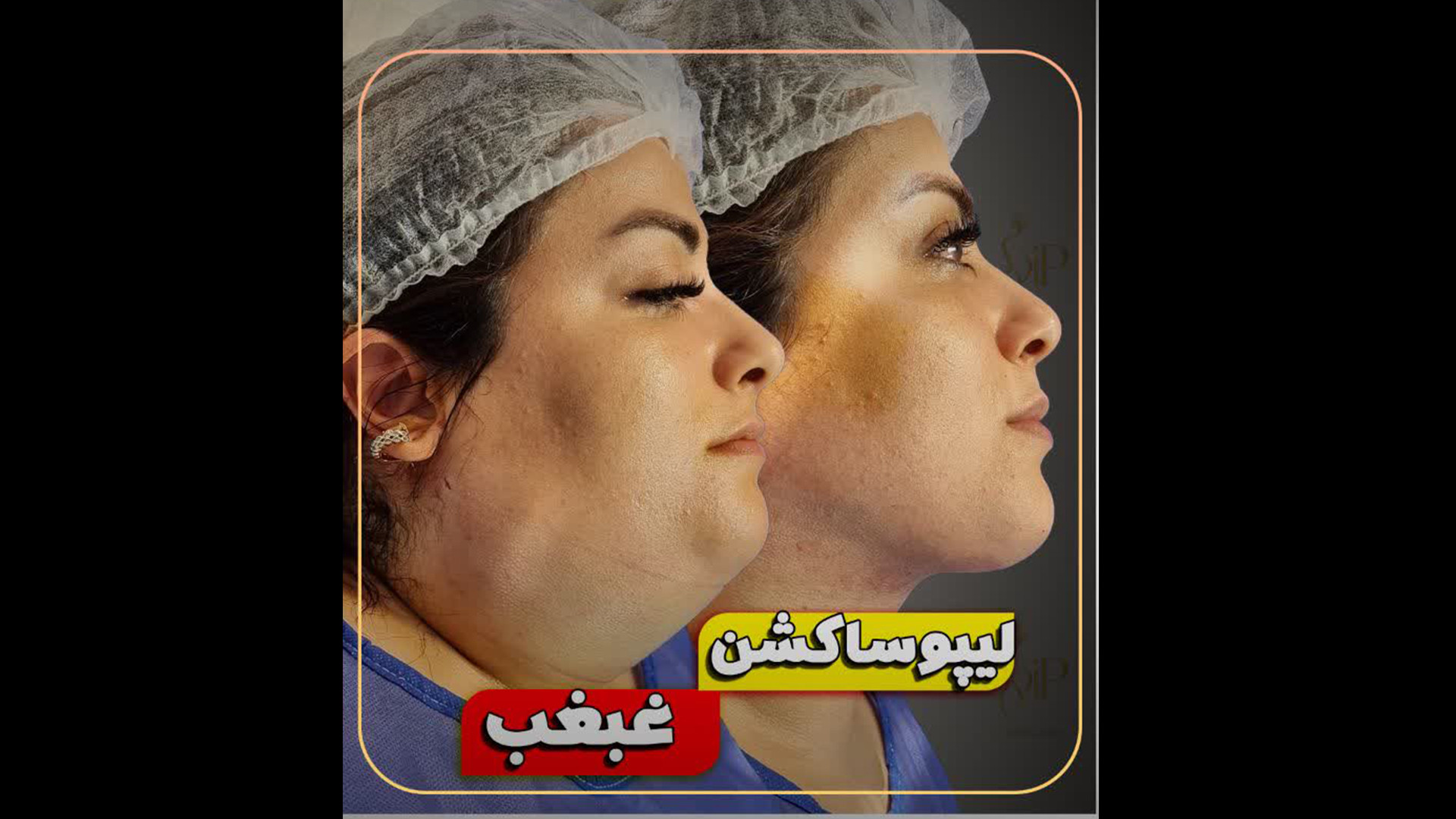 لیپوساکشن غبغب برای مشتری عزیز قبل و بعد آوتوپلیسوماب