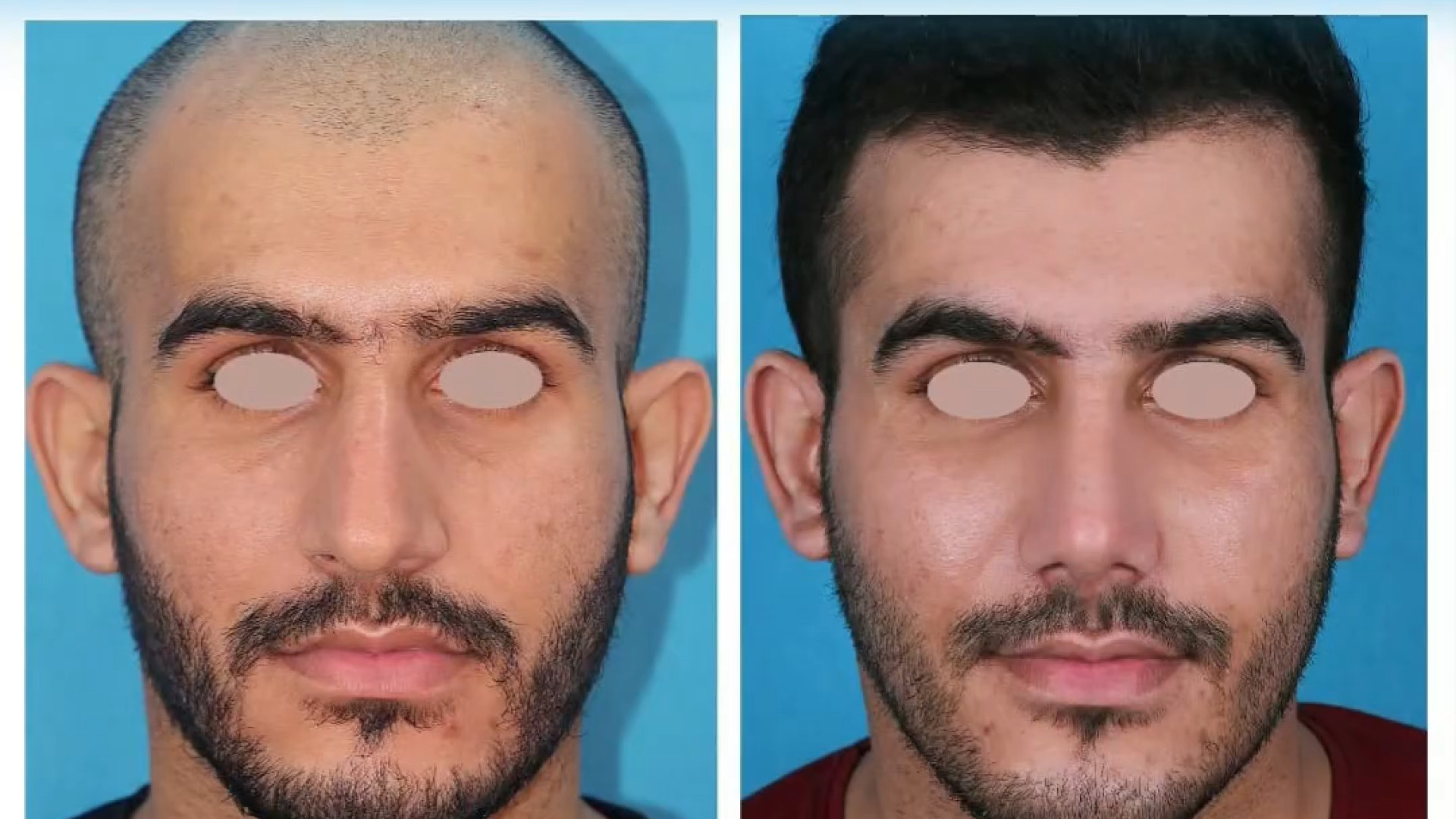 عمل بینی آقایان دکتر علی جمشیدی