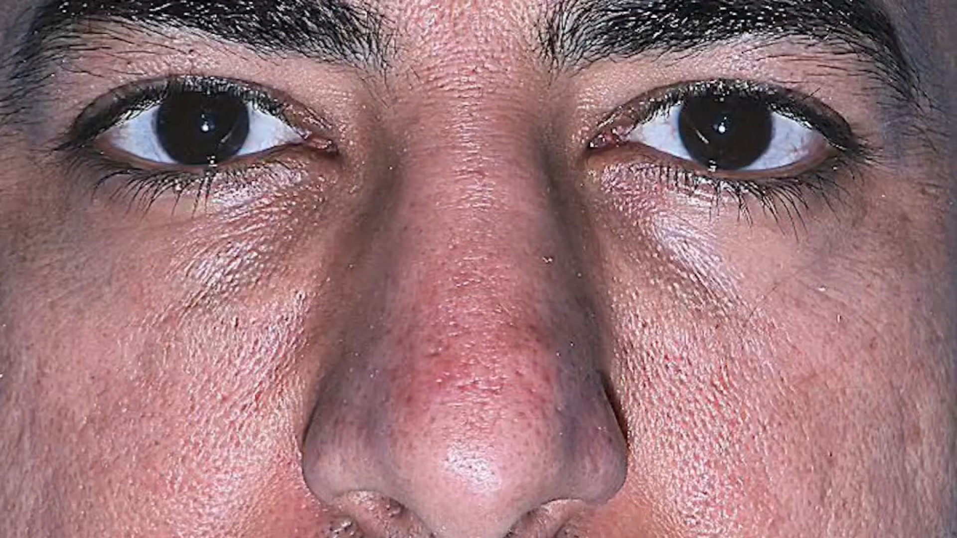 ۳ ماه بعد از عمل سپتو رینو پلاستی دکتر علی جمشیدی