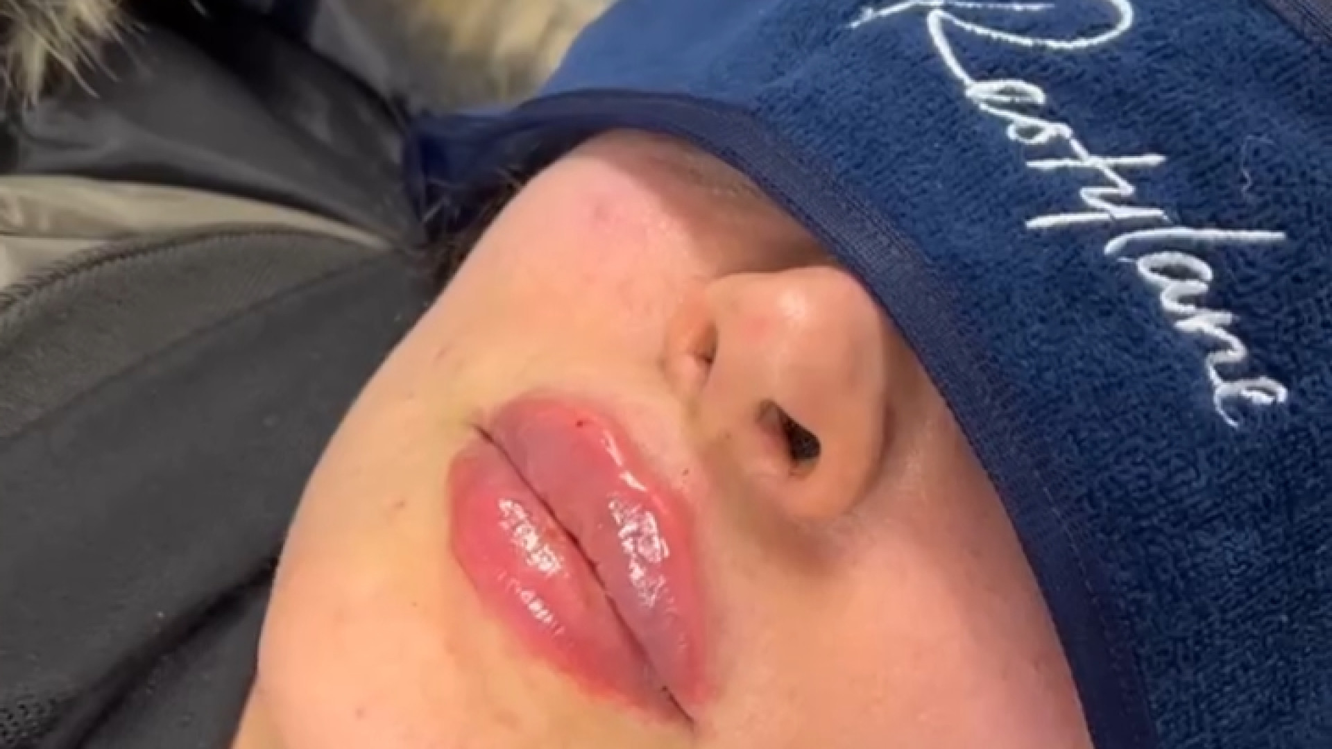 تزریق اول فیلر لب دکتر آریا شفیعی