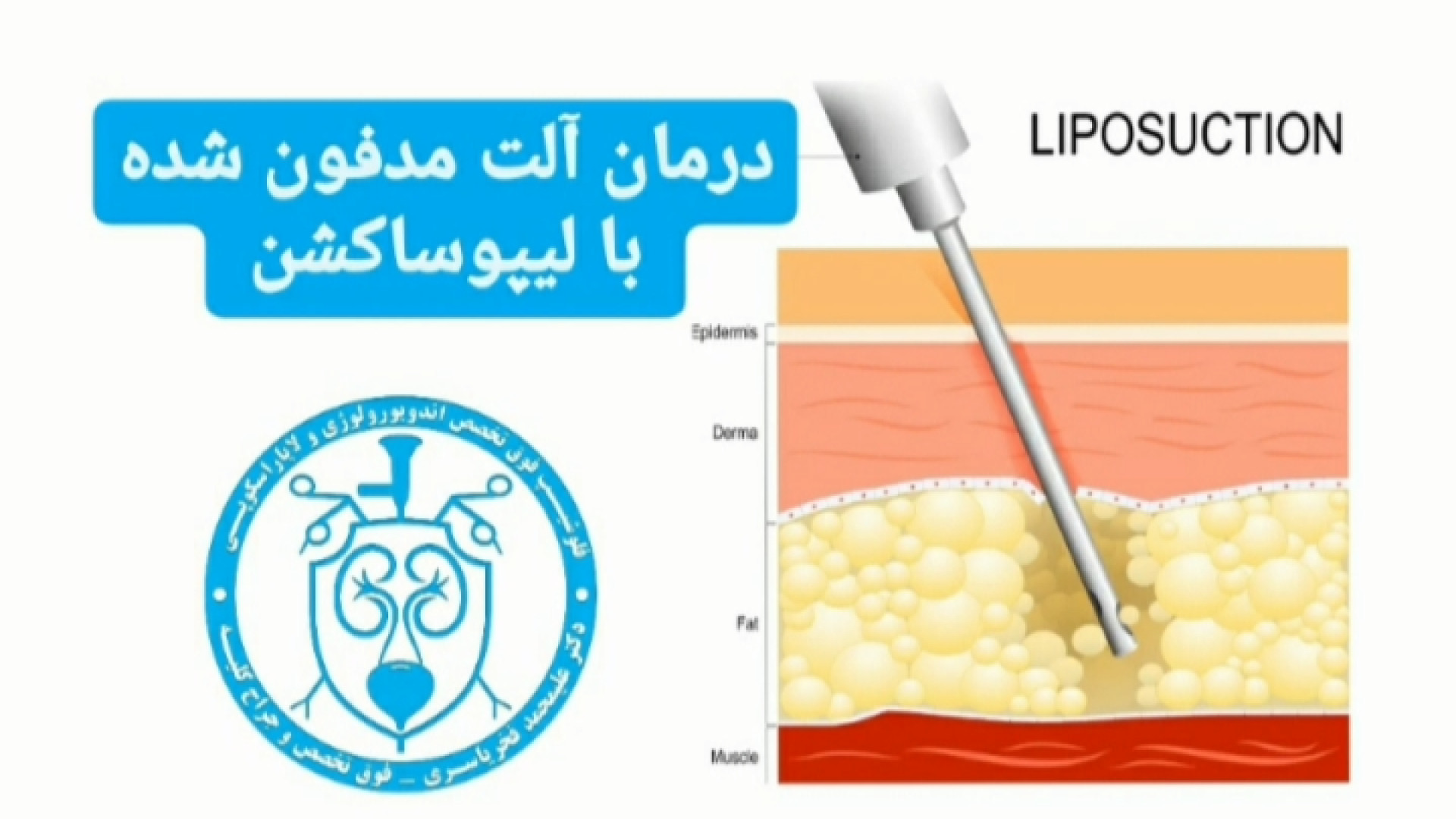 درمان آلت مدفون شده با لیپوساکشن لیزر مو