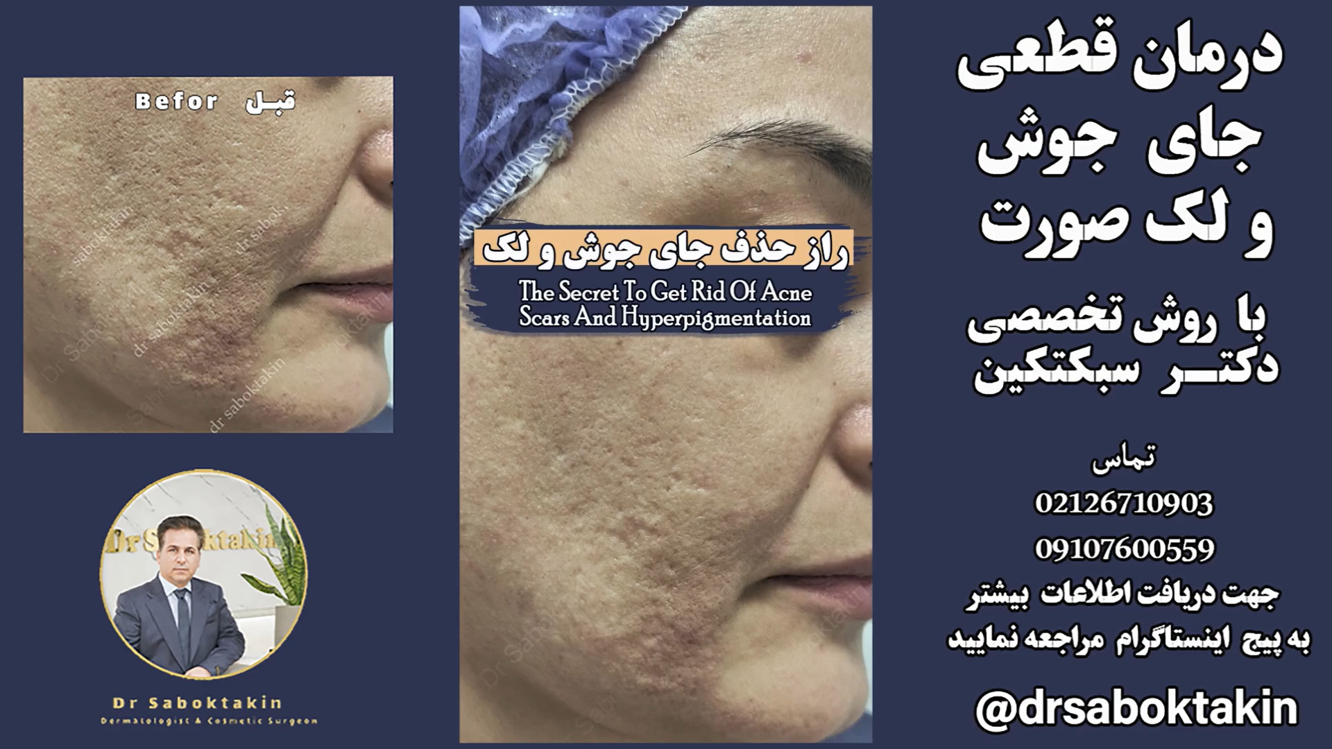 معجزه درمان لک و جای جوش صورت تا بالای 90 % acne scars hyperpigmentation laser ترمیم سوختگی
