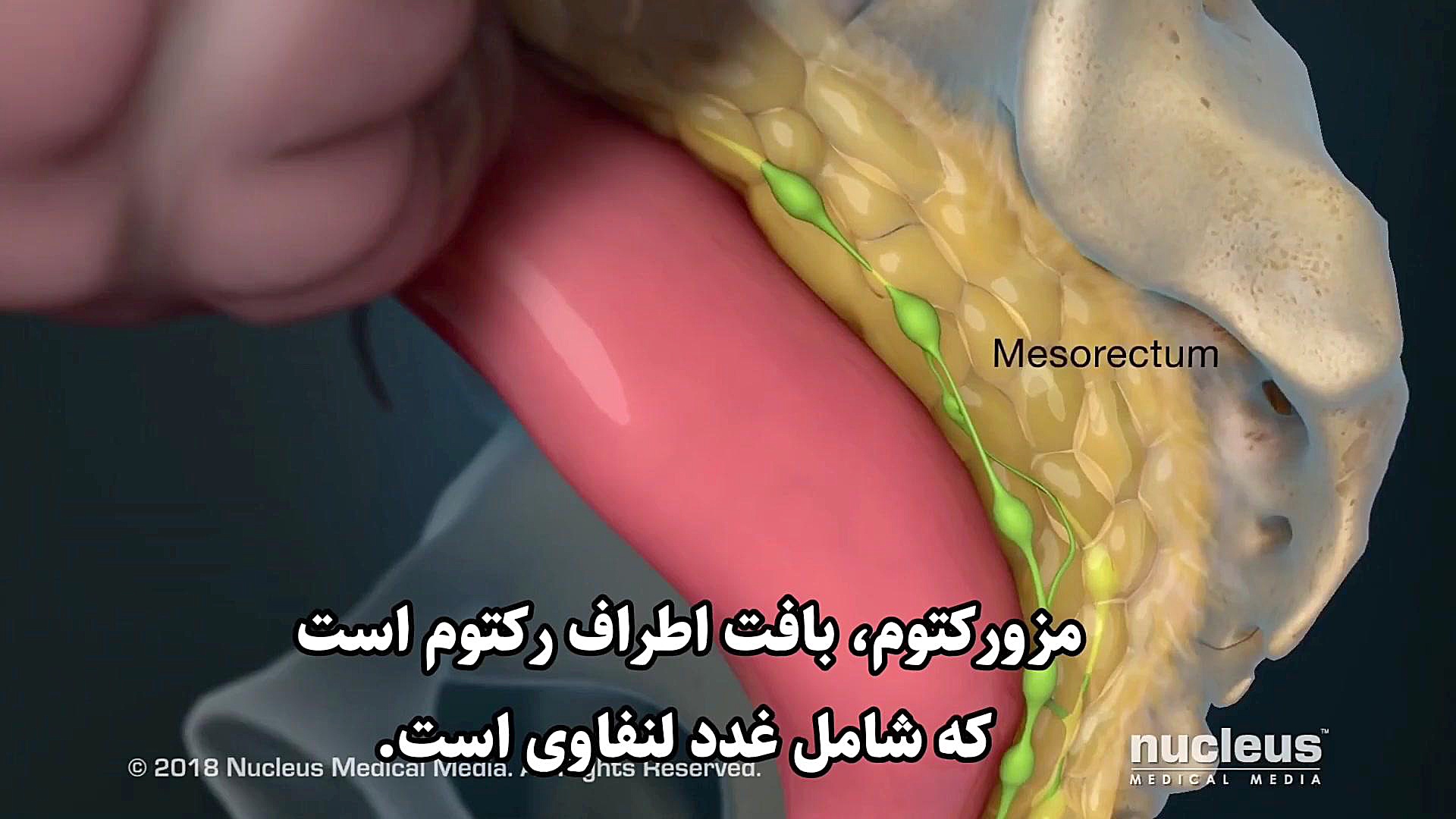 جراحی سرطان رکتوم(راست روده) لیپوست