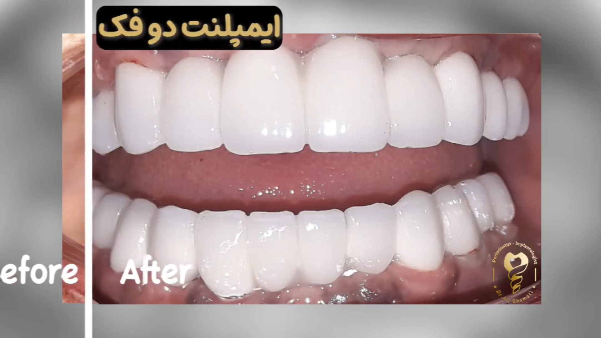 جراحی ایمپلنت دندان دو فک دکتر علی قمری - متخصص جراحی لثه و ایمپلنت