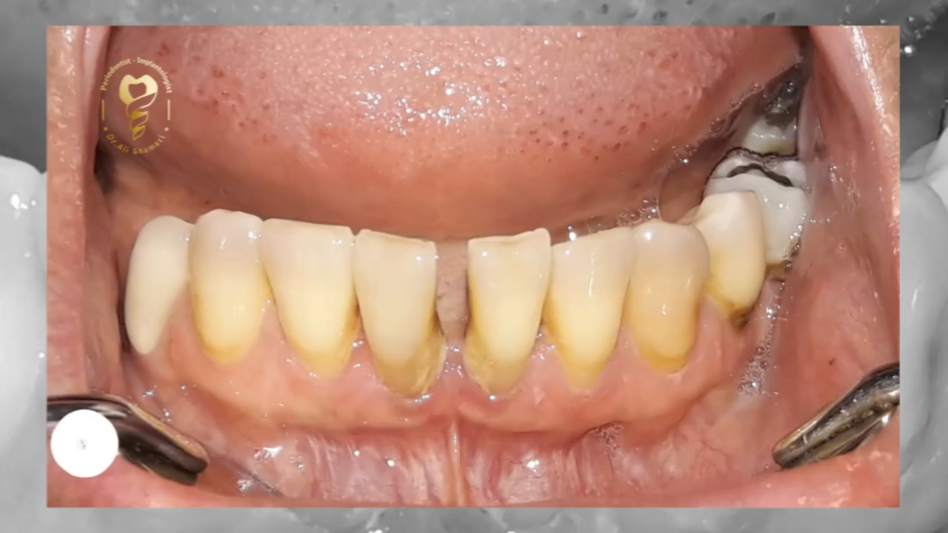 جراحی پیوند لثه فک پایین لوسارتان