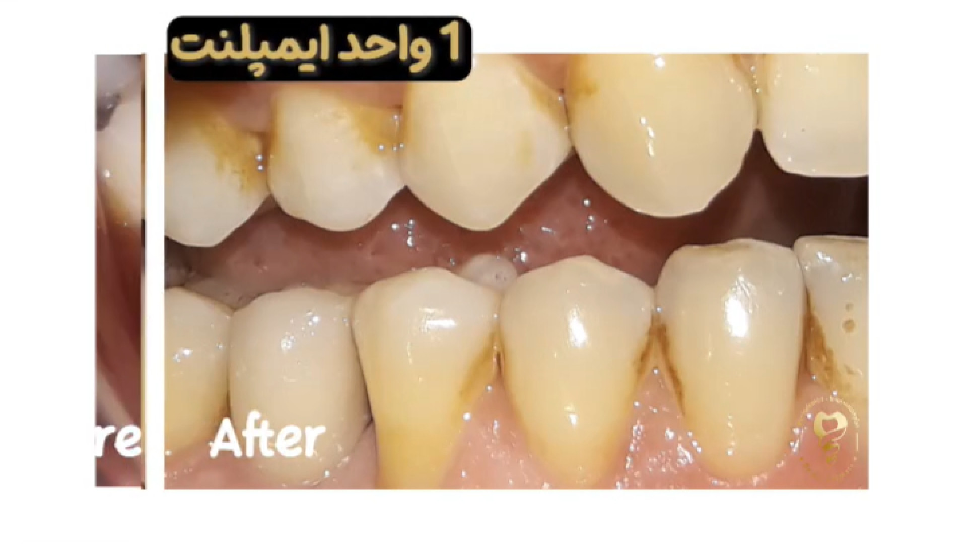 جراحی ایمپلنت دندان یک واحد دکتر علی قمری - متخصص جراحی لثه و ایمپلنت