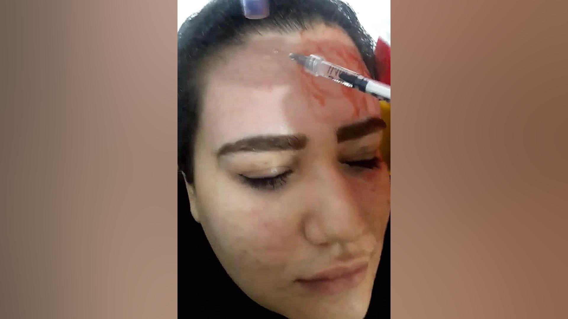 میکرونیدلینگ پلاسماجت درمان لک ملاسما بیماری شوگرن