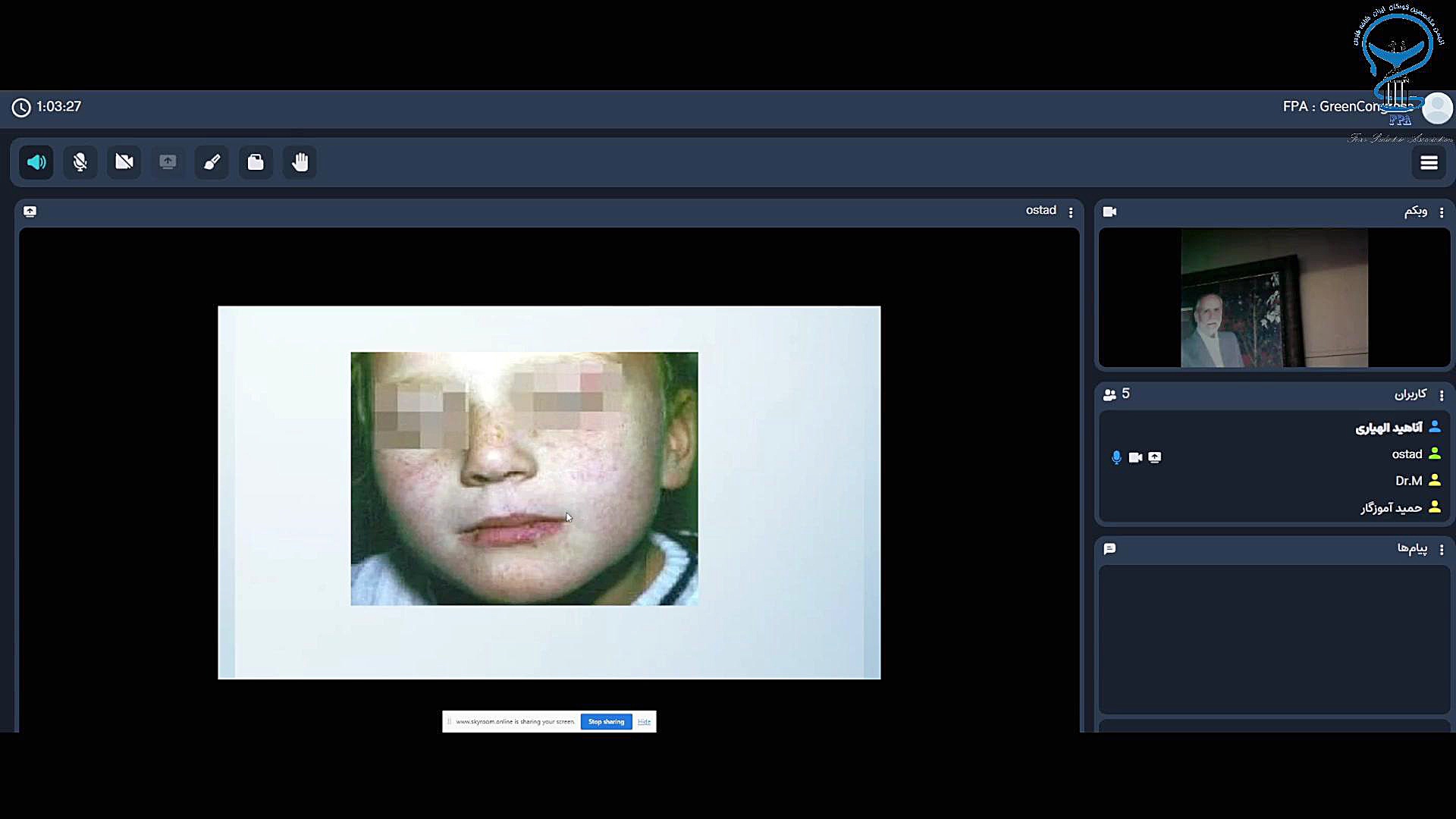 یک بیماری مرموز در بیماران با پلی سیتمی یا استروک یا سیروز یا تنگی نفس لیپوماتیک