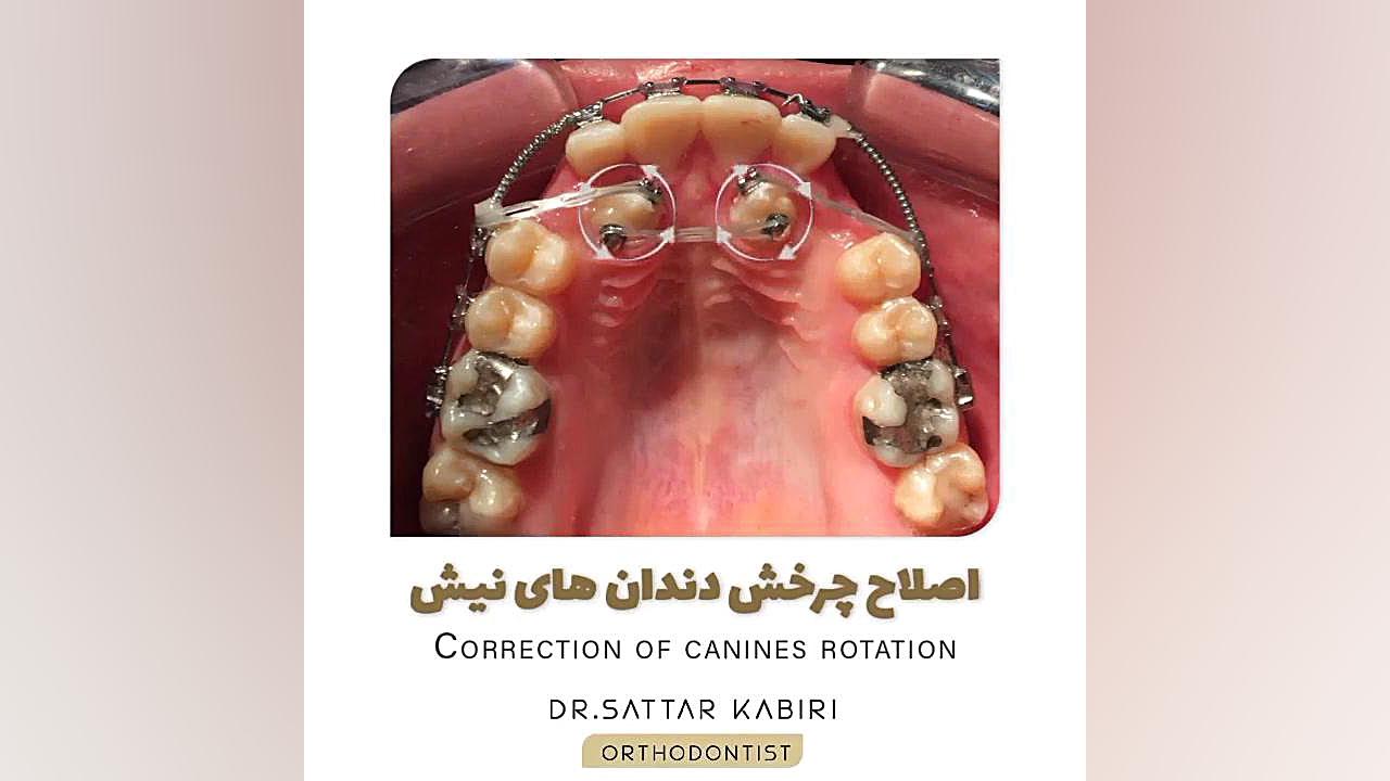 اصلاح چرخش دندان های نیش کلینیک زیبایی