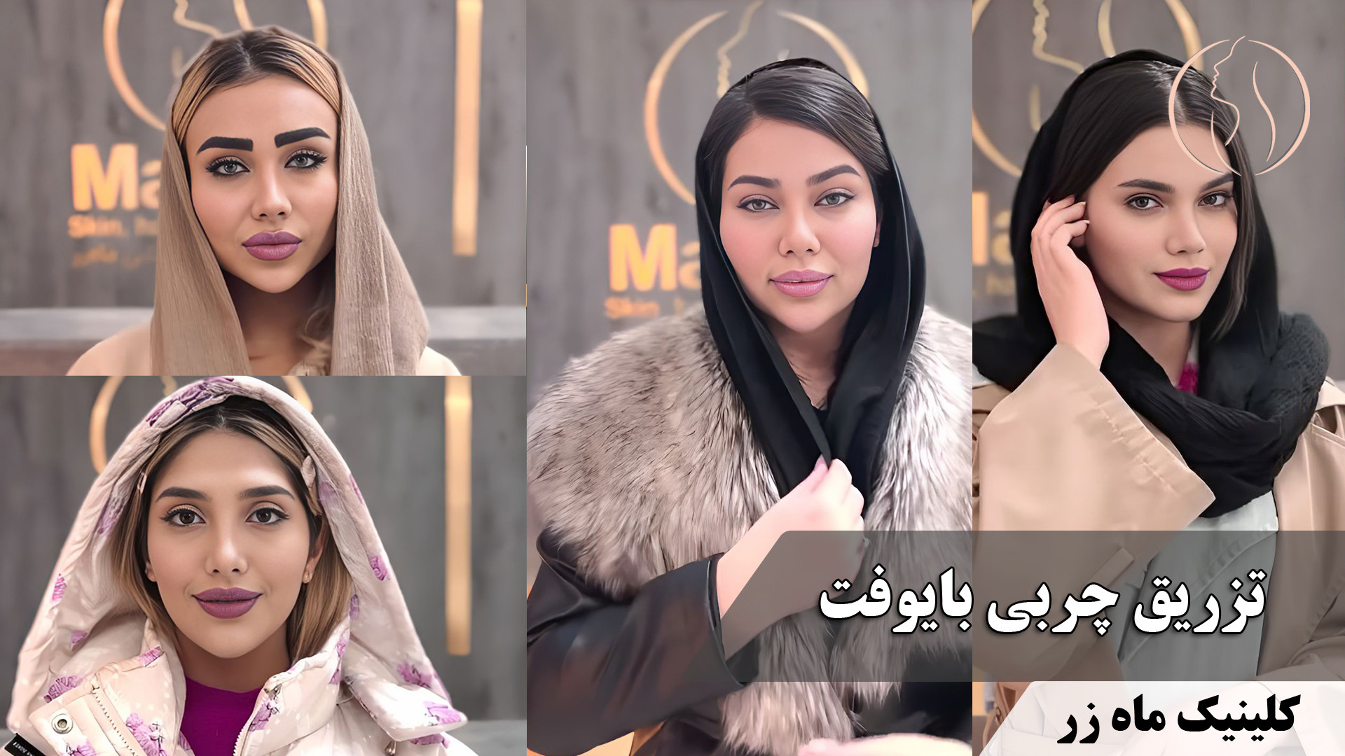 تزریق چربی به روش بایوفت ( کلینیک زیبایی ماه زر ) ریژنراتیو مدیسین