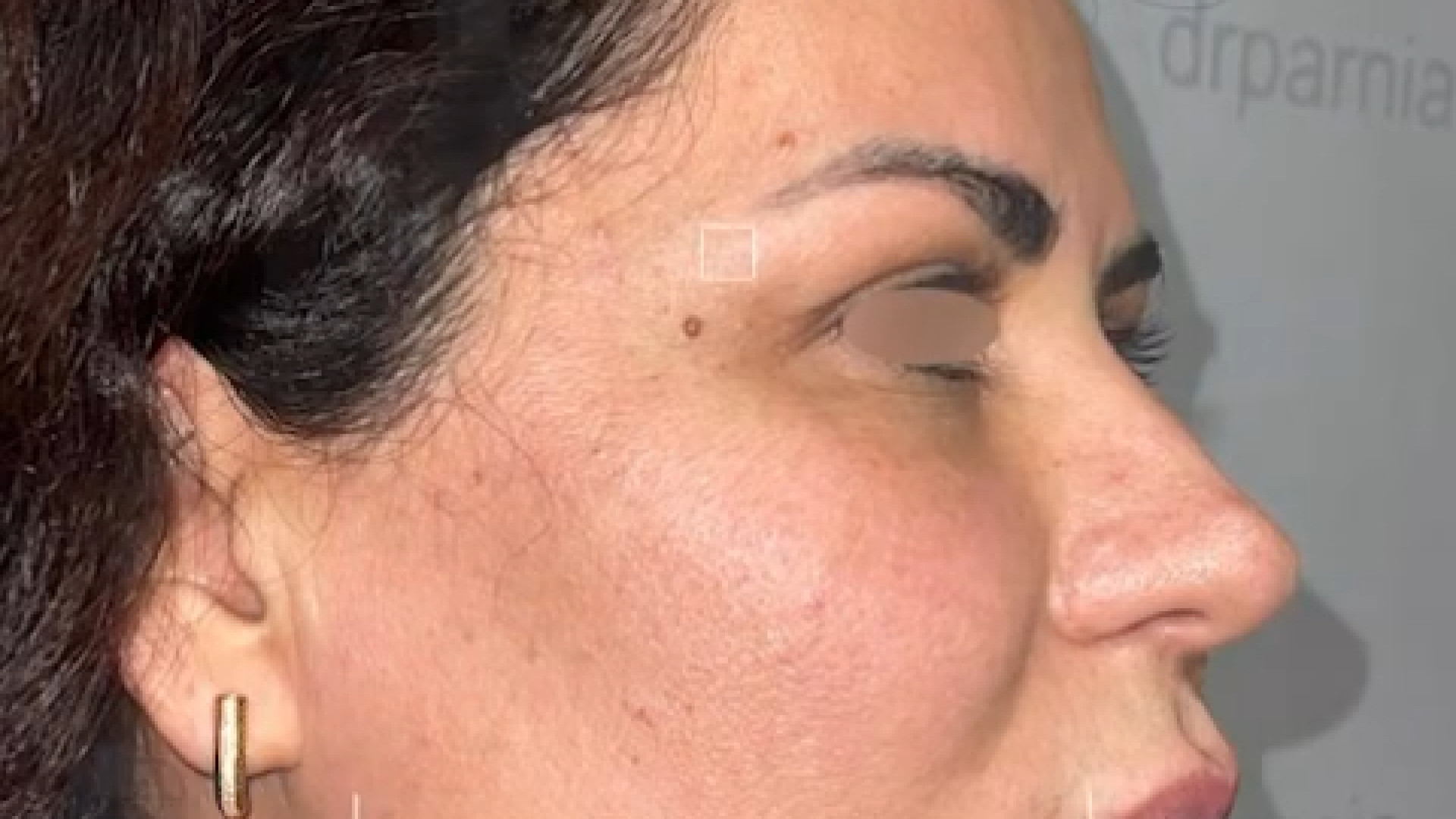 لیفت اندوسکوپ پیشانی و ابرو و بلفارو و ترمیم بینی دکتر رفیع پرنیا فوق تخصص پلاستیک