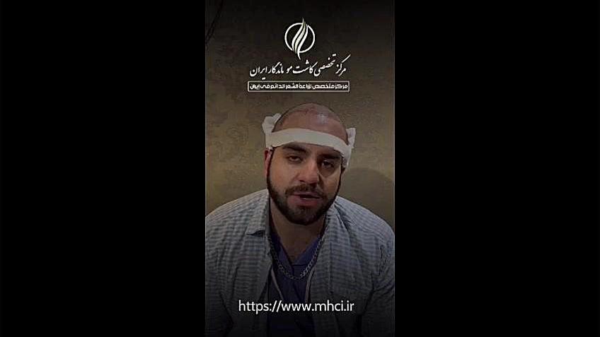انتخاب کاشت مو به روش SUT پزشکی نانوذره‌ای