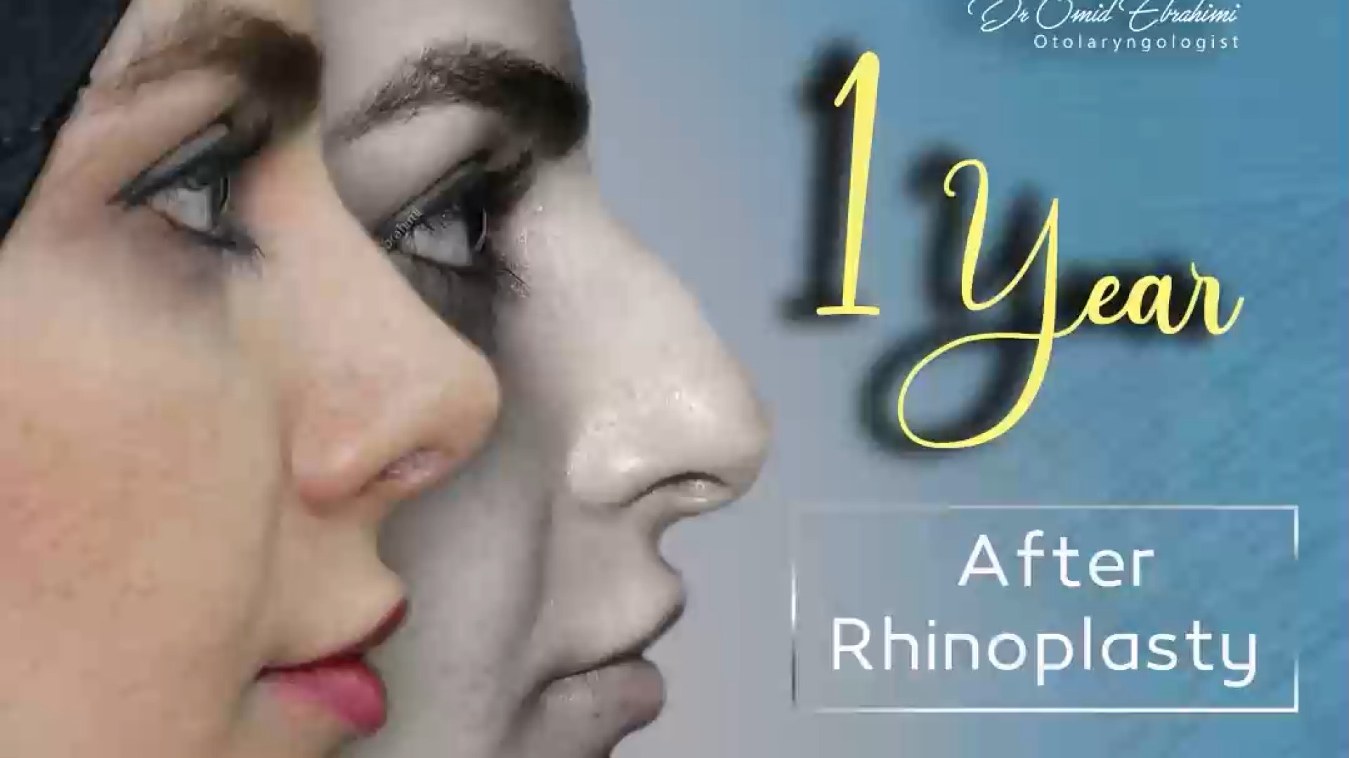 نتیجه جراحی بینی بعد از یکسال توسط دکتر امید ابراهیمی دکتر امید ابراهیمی