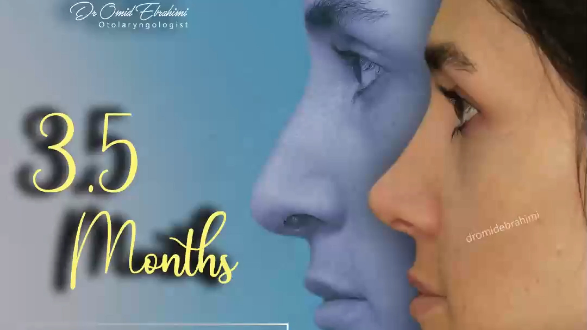 3 ماه بعد از عمل بینی توسط دکتر امید ابراهیمی، بهترین جراح بینی در تهران دکتر امید ابراهیمی