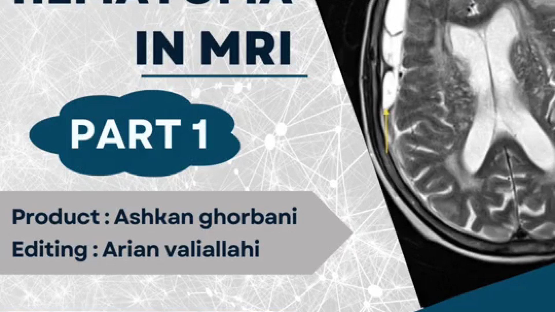 HEMATOMA IN MRI Part 1- هماتوم در ام آر آی قسمت اول بلیچینگ