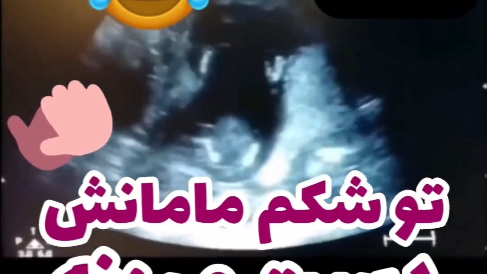 حرکت جنین حین سونوگرافی دکتر مژگان بیک زاده ( جراح و متخصص زنان و زایمان)