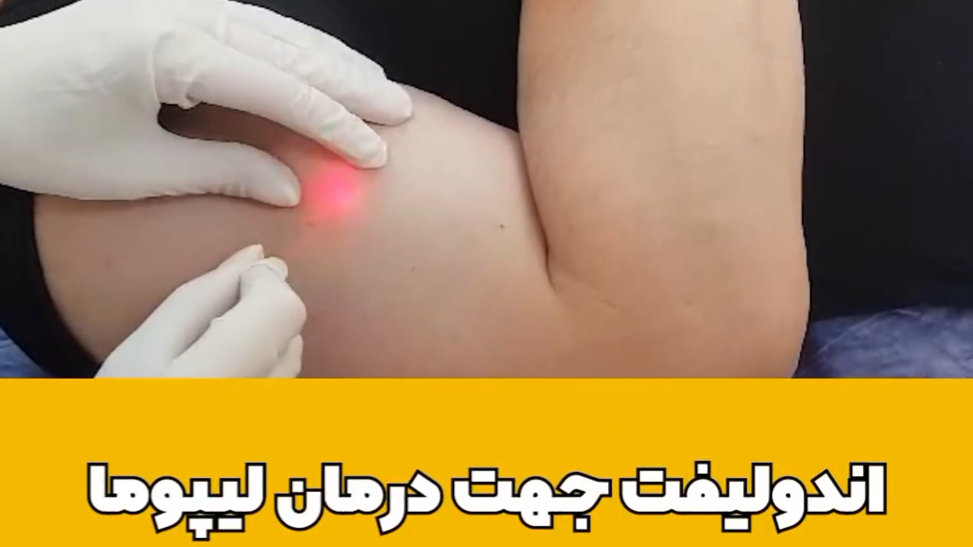 درمان لیپوما با اندولیفت دکتر حمیده آقایی