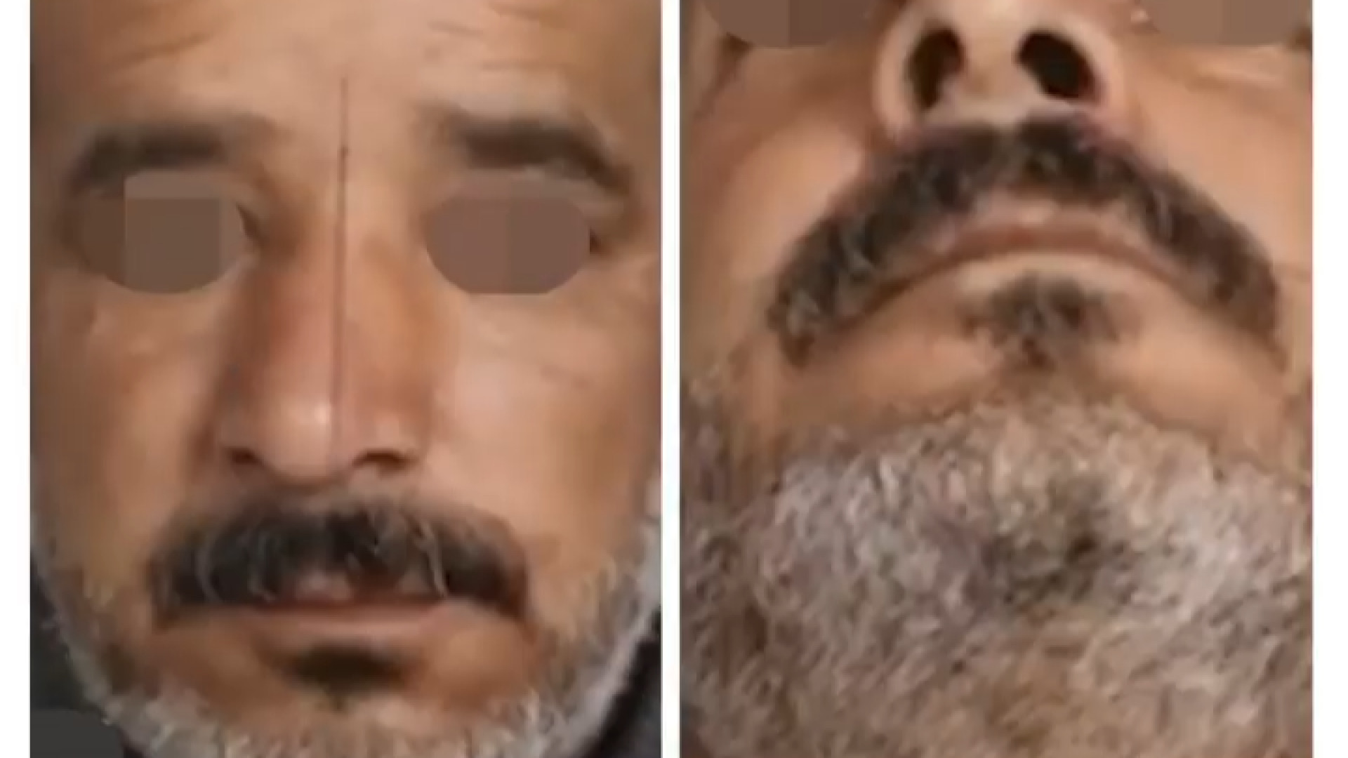 جراحی زیبایی بینی دکتر مهدی قدیری