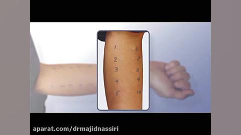 تست آلرژی یا ایمونوتراپی آلرژی کریستیانو رونالدو