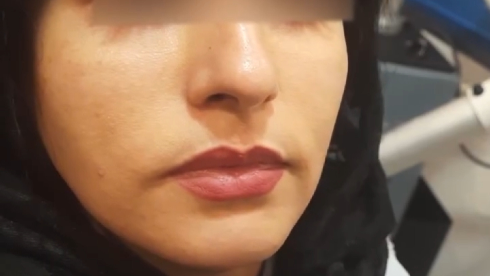 تزریق فیلر گونه دکتر پروین طاوسی - متخصص پوست، مو و زیبایی