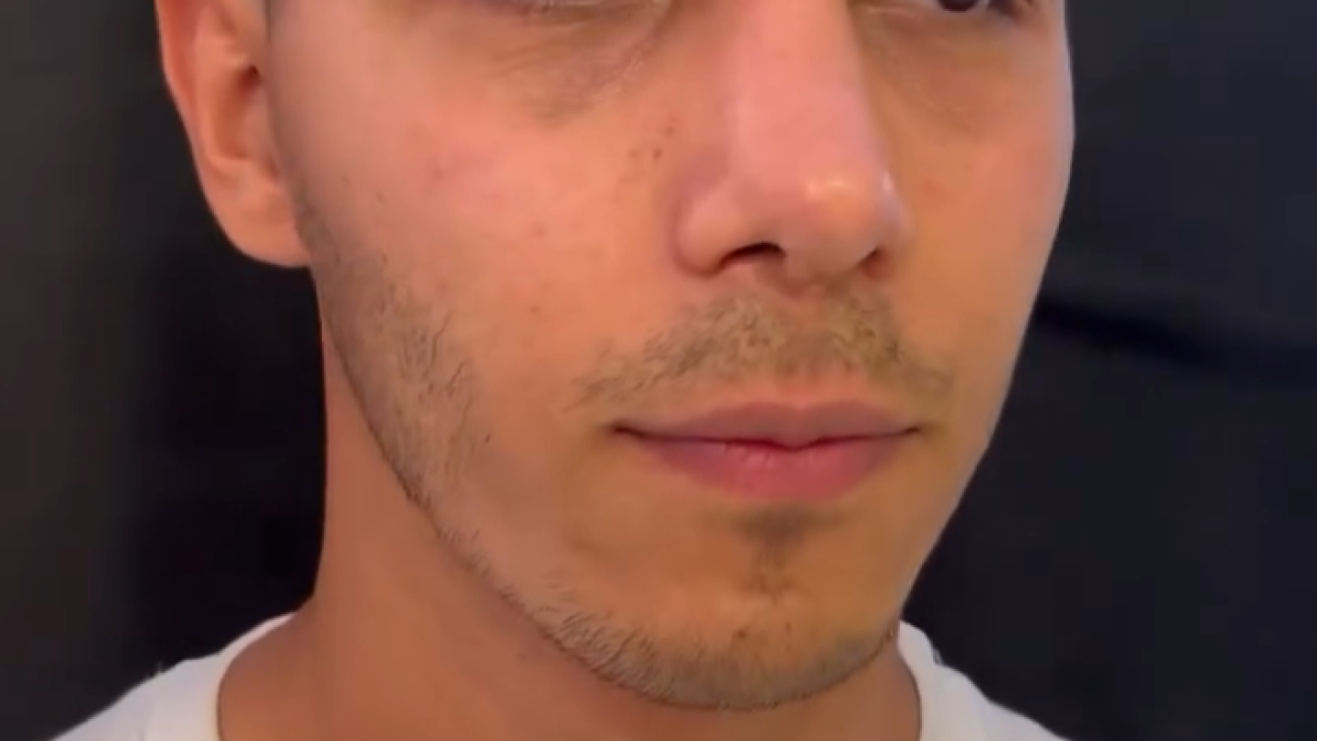 ۳ ماه بعد از جراحی بینی دکتر شاهین بهجو - فوق تخصص جراحی پلاستیک