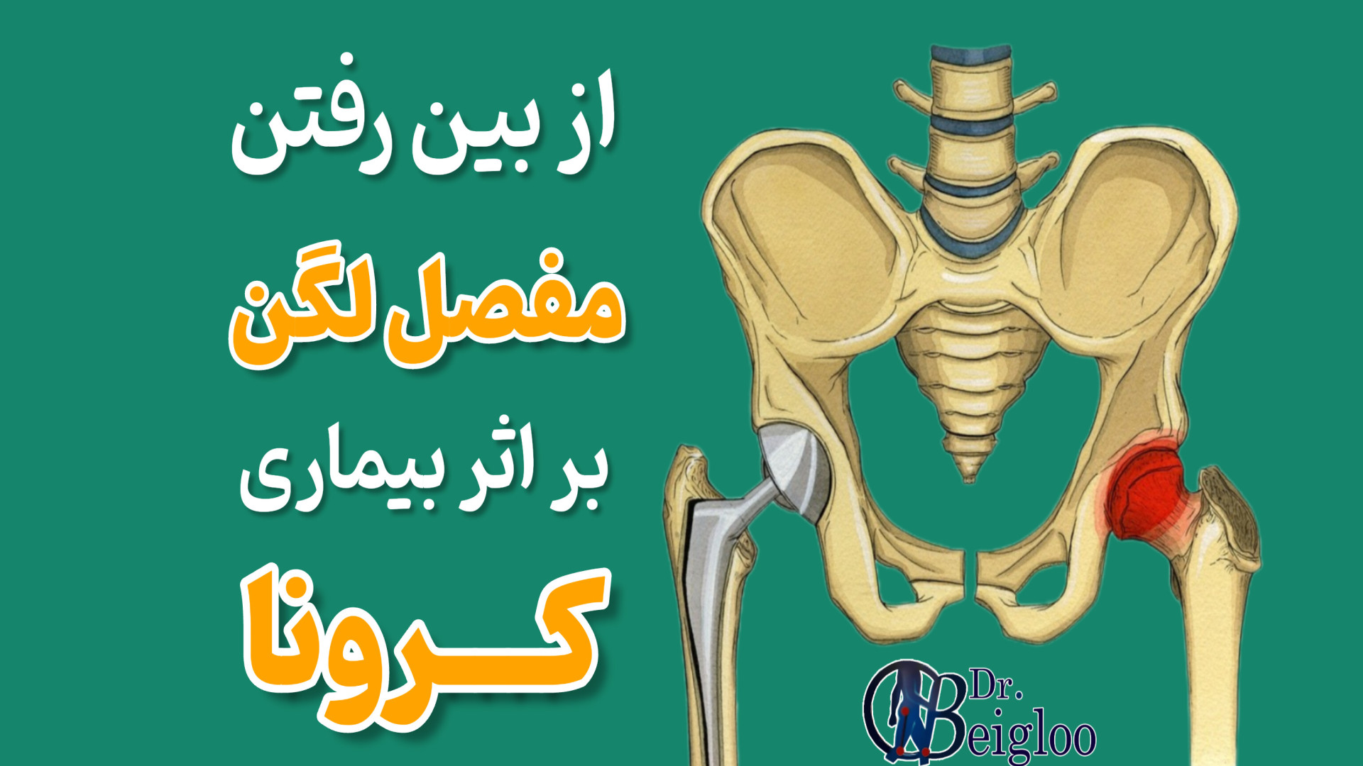 از بین رفتن مفصل لگن بر اثر بیماری کرونا دکتر محمود جعفر بیگلو