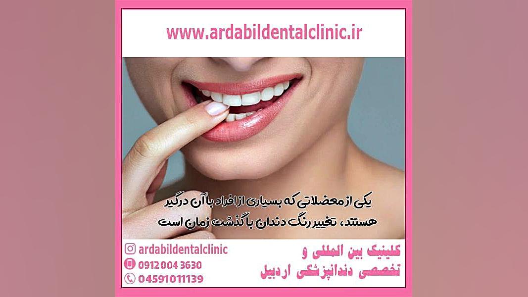 بلیچینگ دندان چقدر دوام دارد بایوفیزیک پزشکی